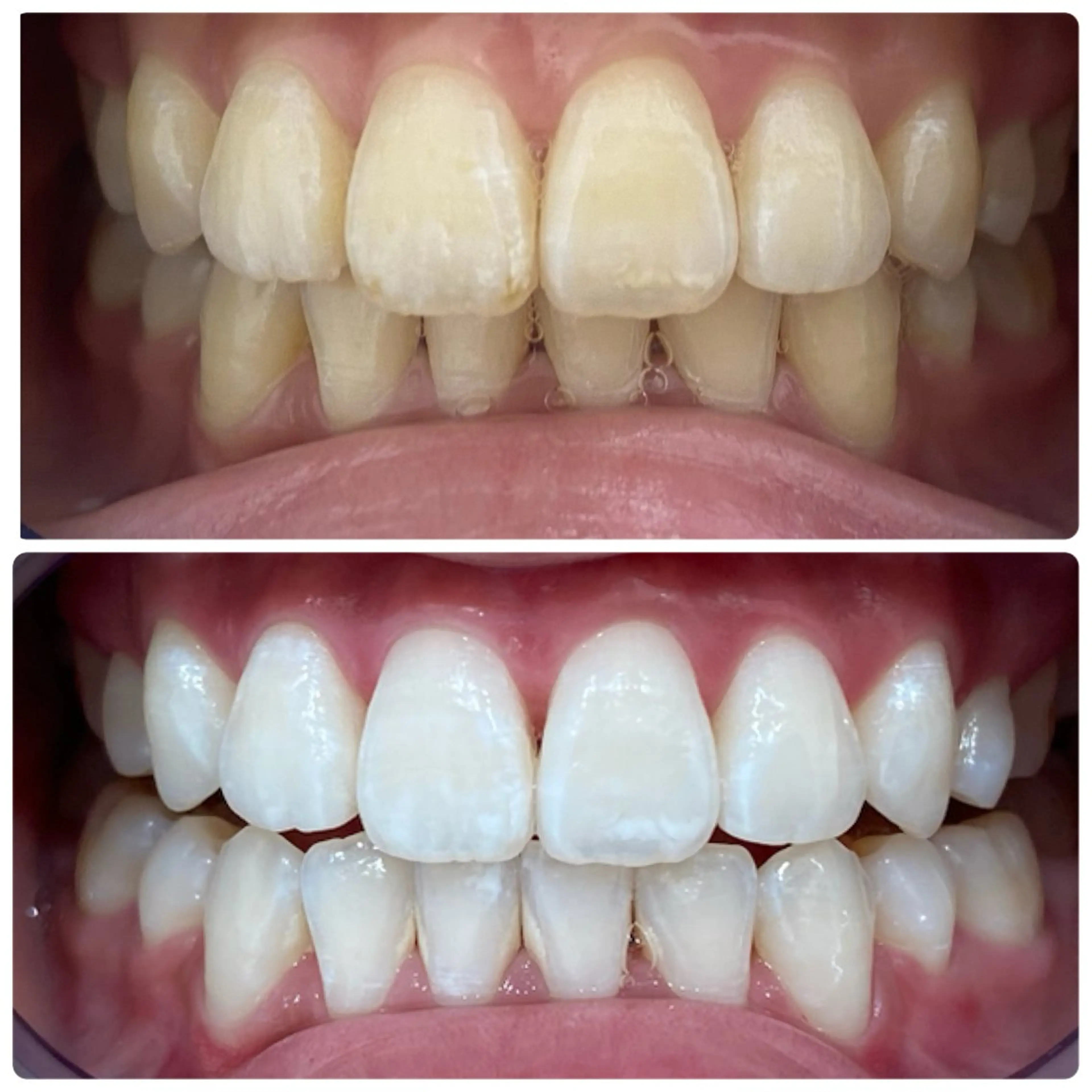 👩🏻‍🎓学生必見👩🏻‍🎓 学生限定のホワイトニング✨️(口コミ投稿あり)の写真