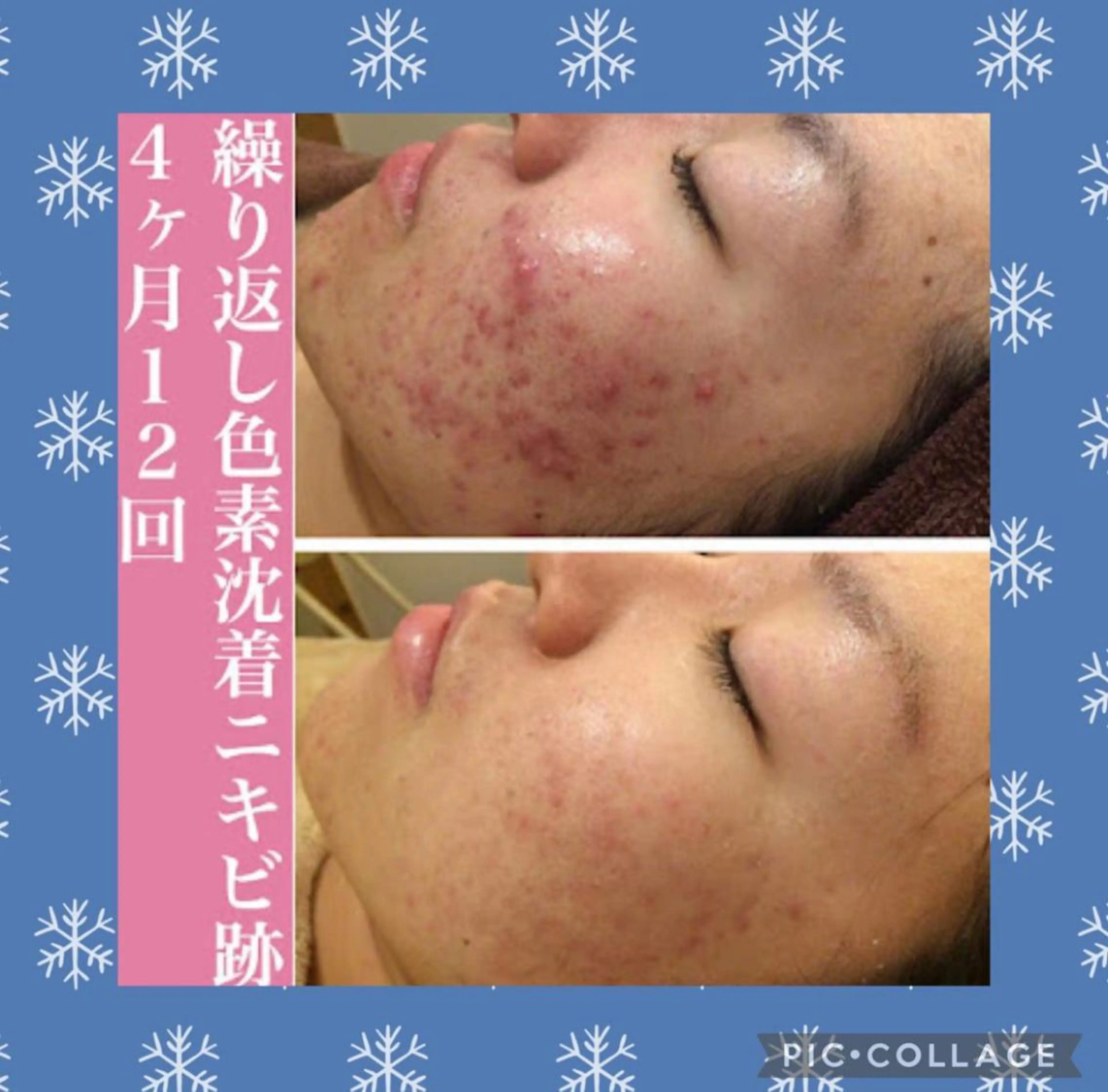 3か月で肌革命👼 ニキビ専門店💫のエステ・リラクイメージ