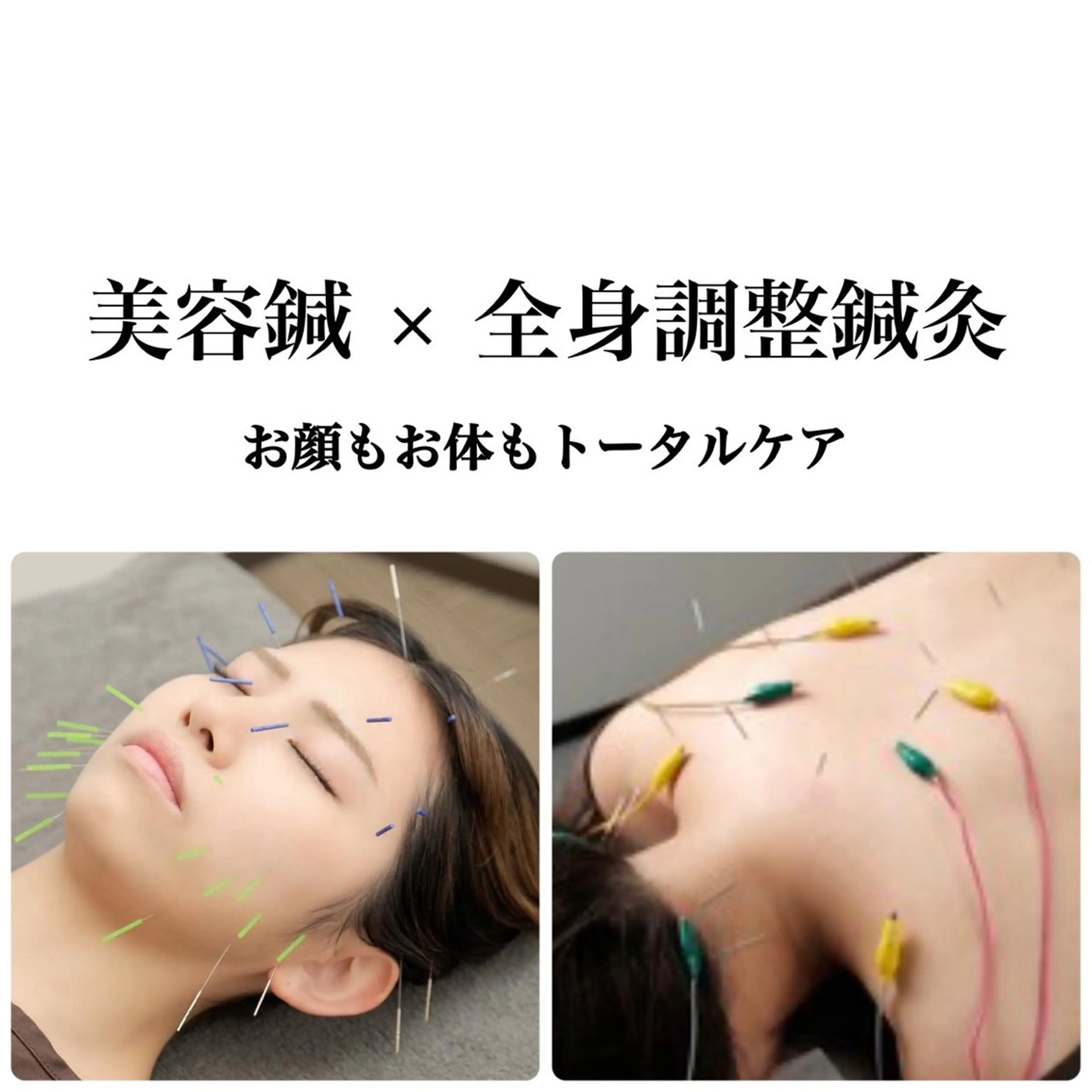【期間限定キャンペーン】人気No.1！贅沢全身鍼灸（90分）の写真