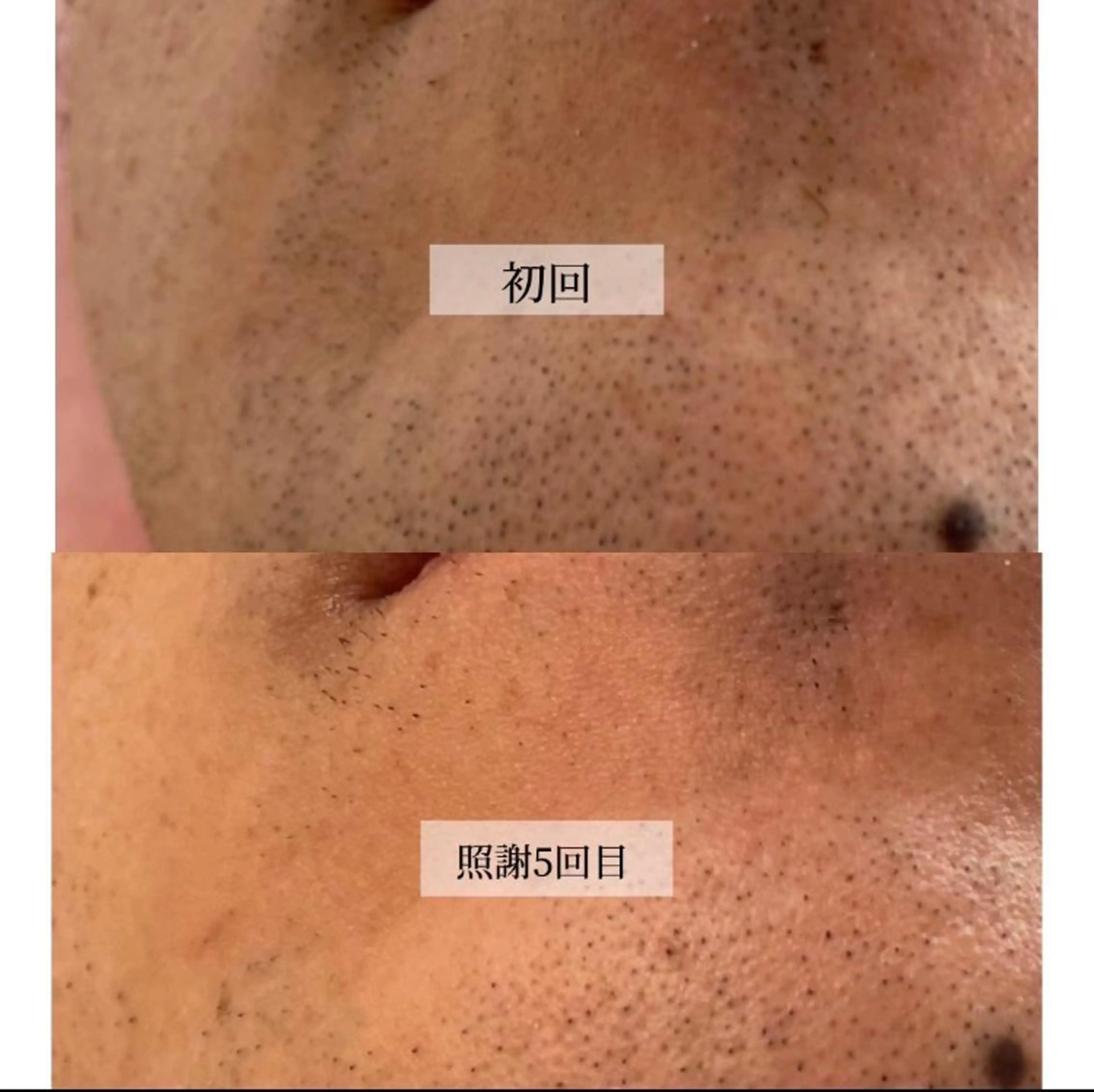 メンズ キッズ マツエク・マツパ 脱毛 江嵜 真由美　　　　甲子園のマツエク・マツパデザイン