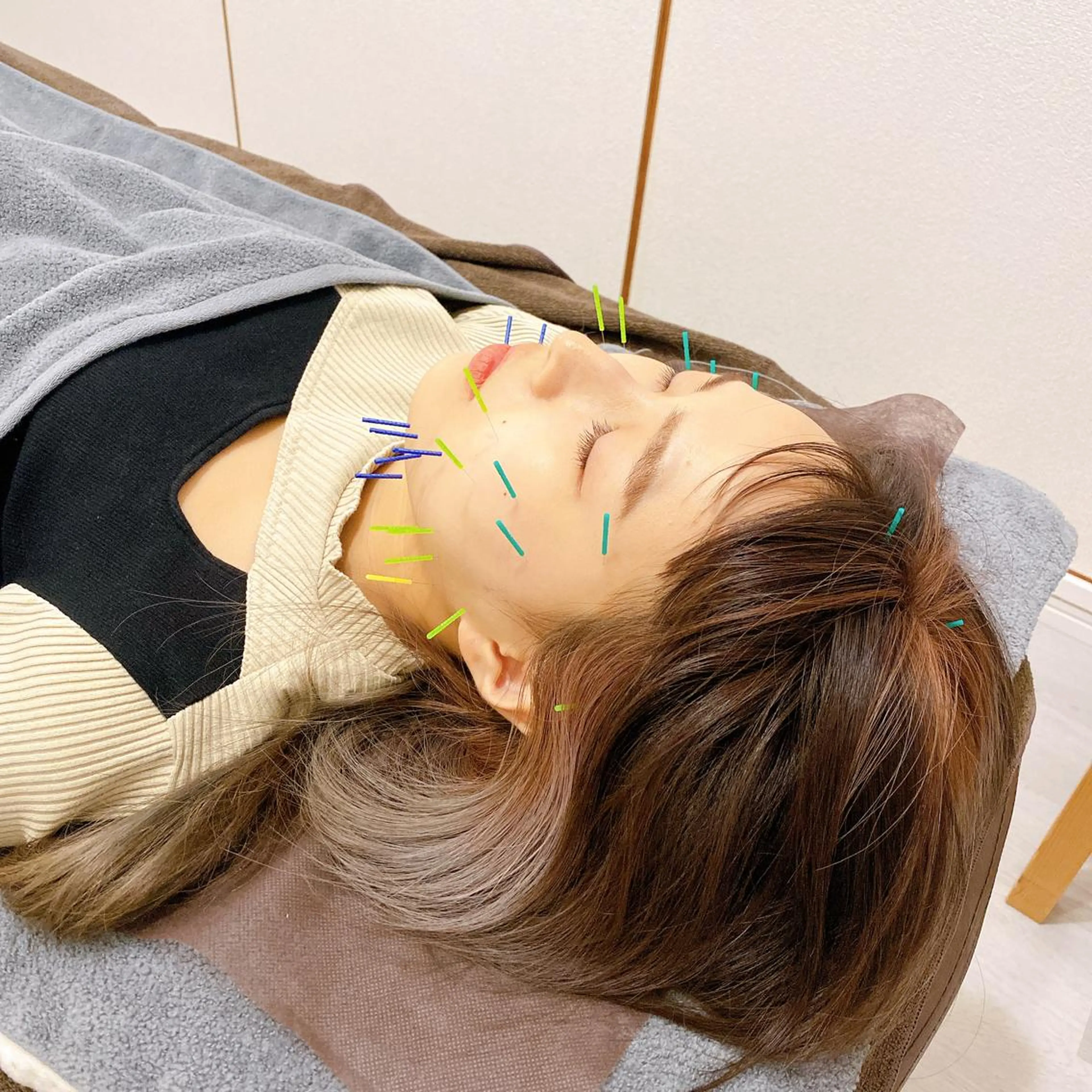 モデル様募集⭐︎［輪郭出し美容鍼］（1度のみ）の写真