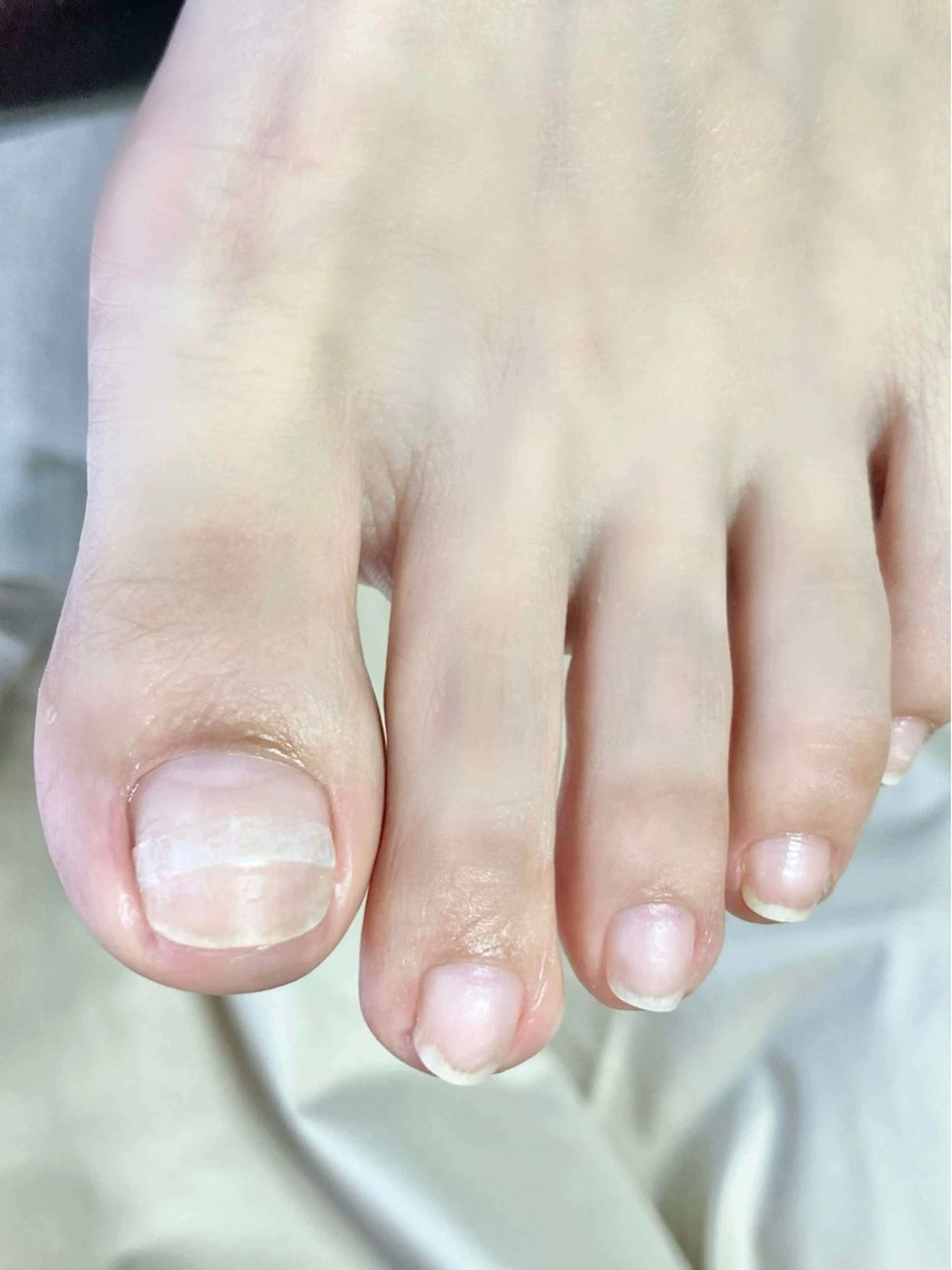 5名様限定✨巻き爪ケアモニター(ケア＋チップ装着)親指1本の写真