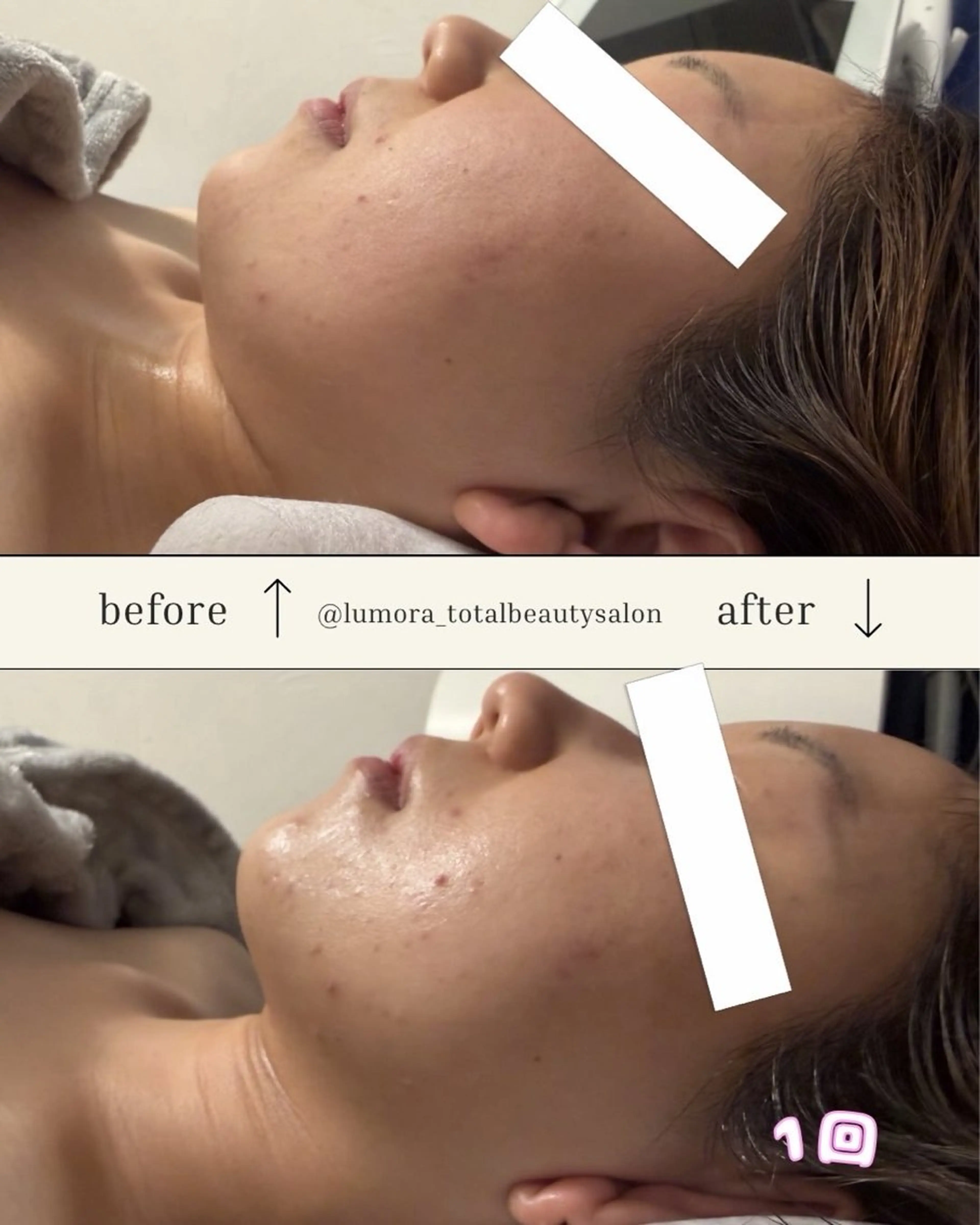 本気で小顔になりたい方🔥話題のマシーンで即小顔🌸✨💫の写真