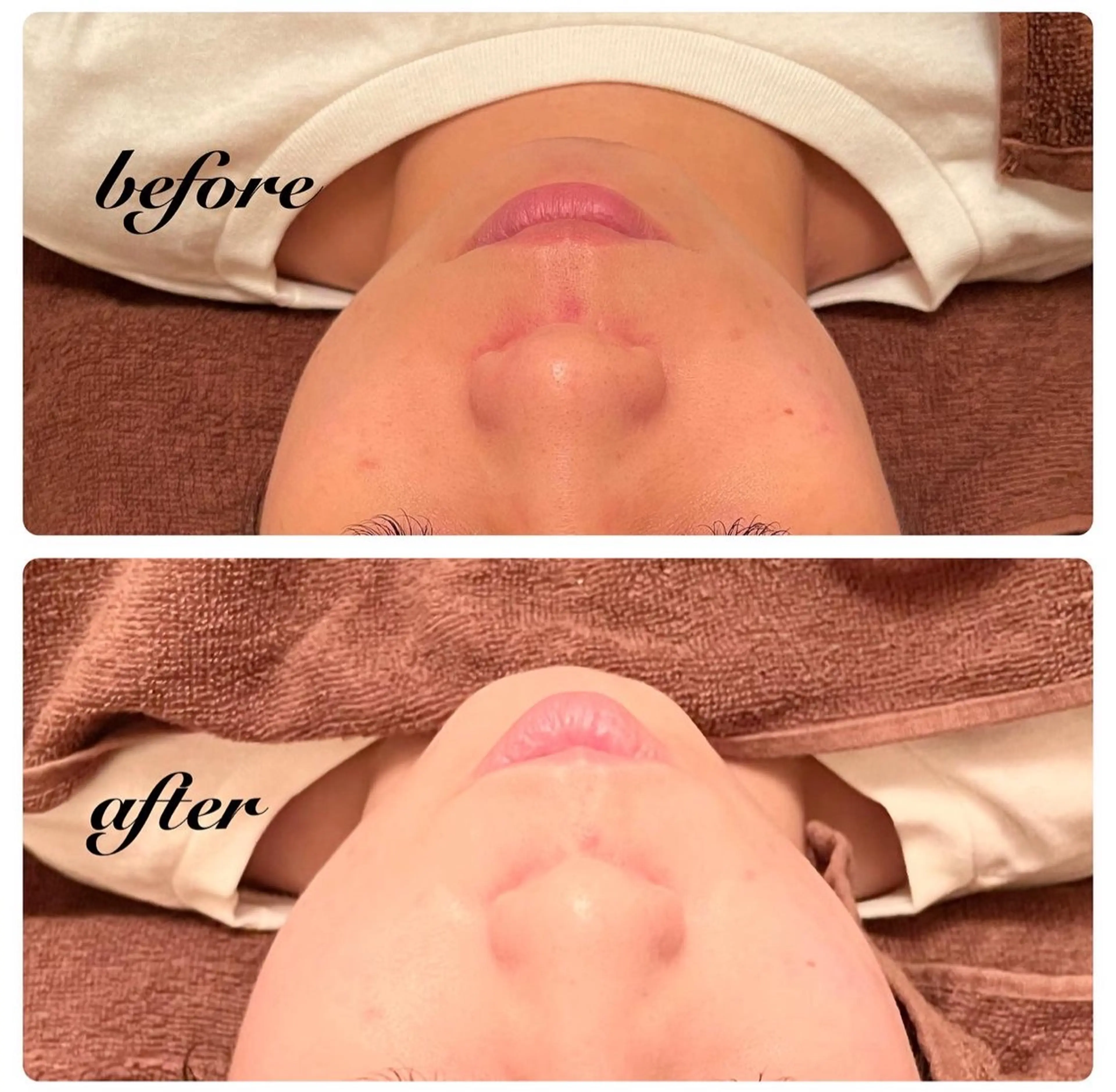 プレミアムエステ(ほうれい線ケア)の写真