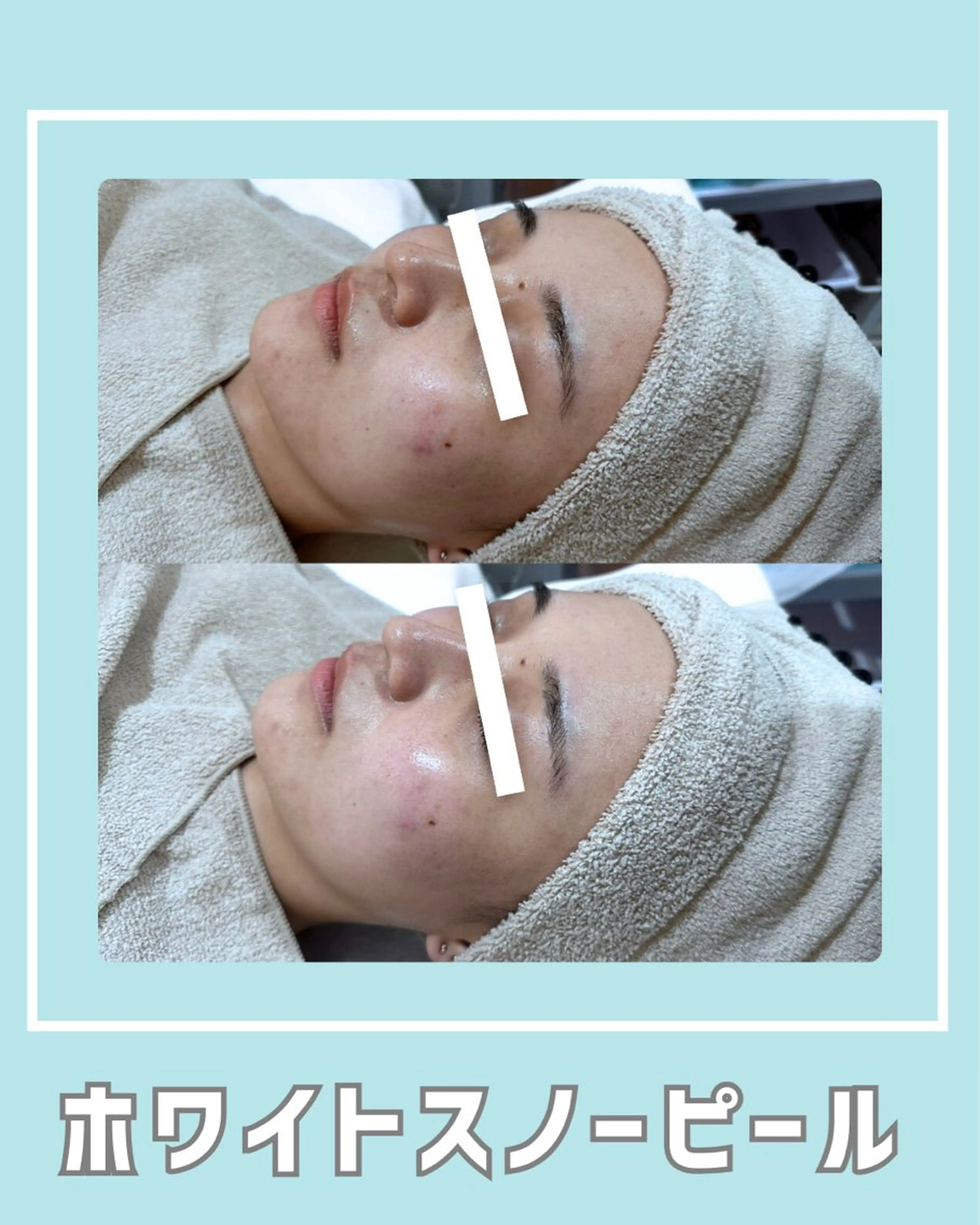 エステ |ピーリング・毛穴| soina神楽坂のエステ・リラクイメージ