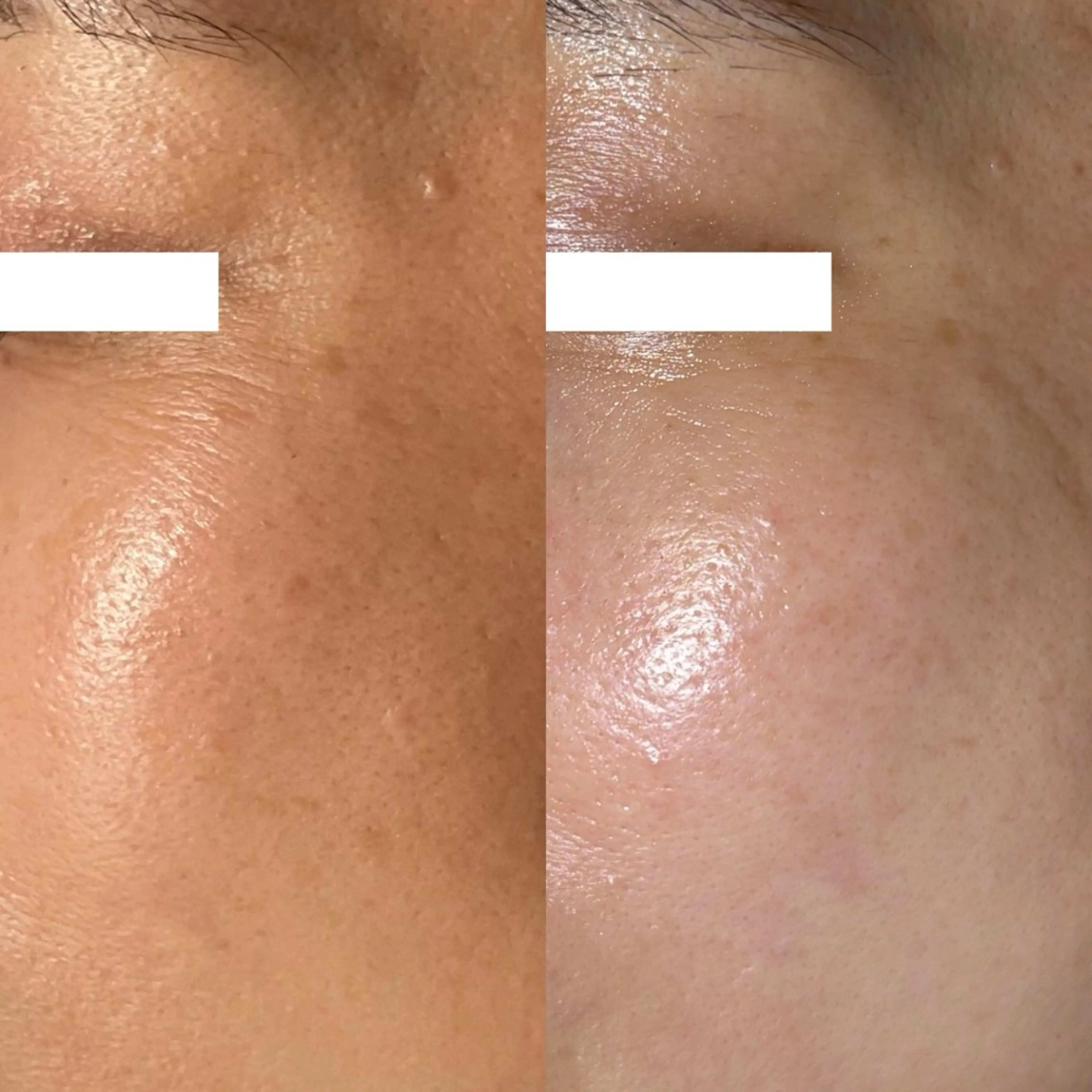 【人気SET🔥】ピーリング＋シミ改善🪄肌の土台からトーンUP✨の写真