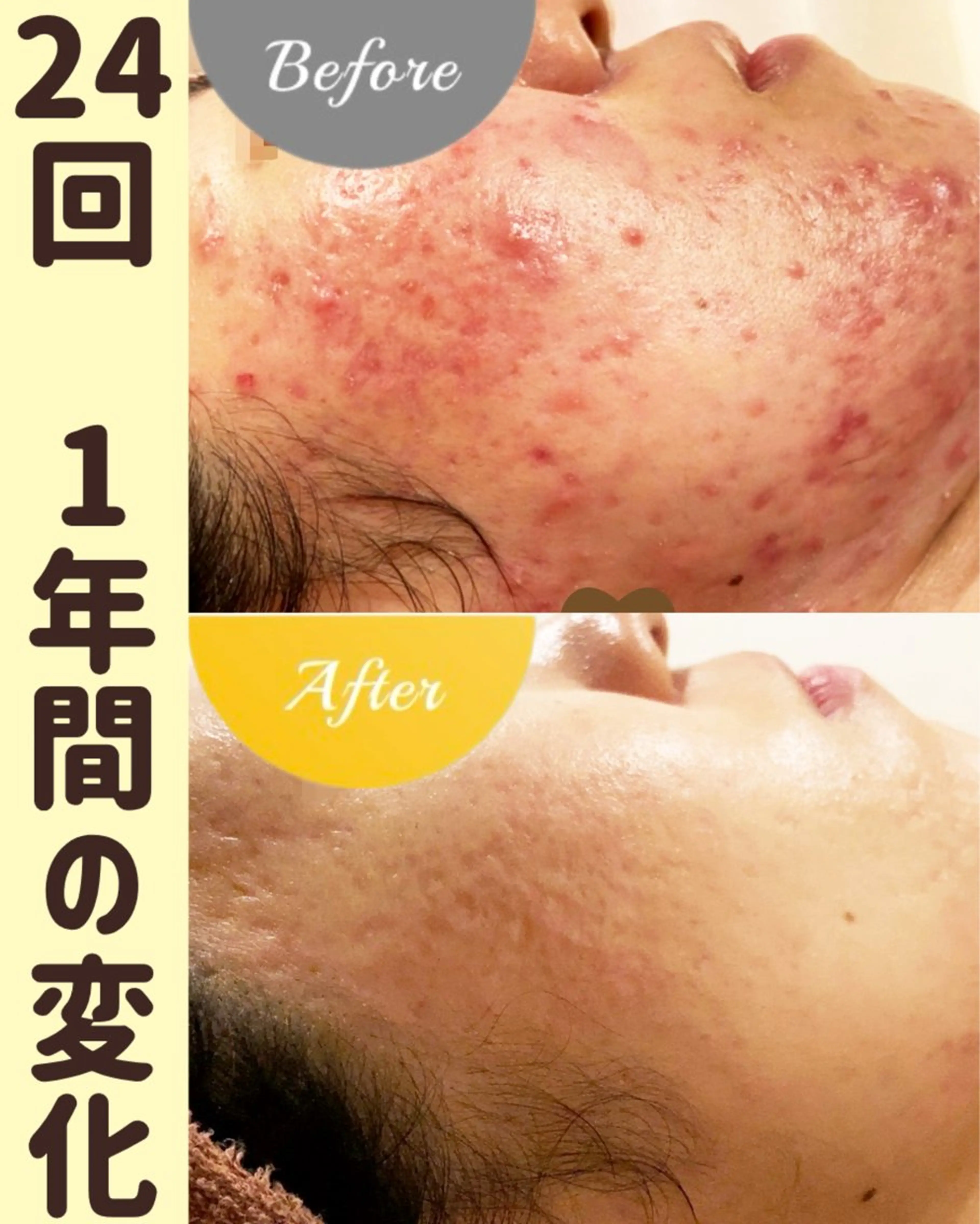 繰り返すニキビ・毛穴 ✨つくば肌質改善専門のエステ・リラクイメージ