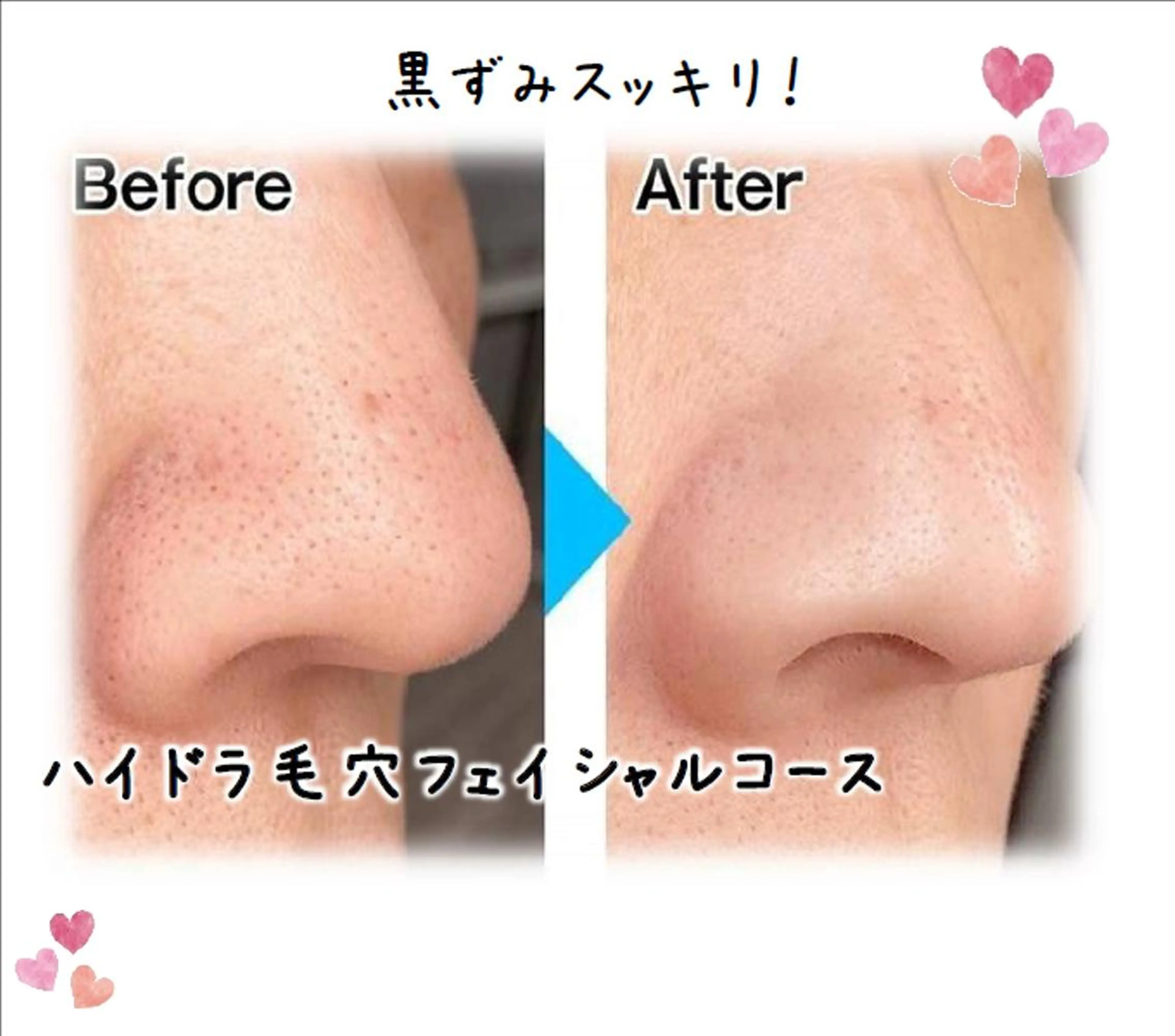 【メンズ限定】毛穴ケア（顔）の写真