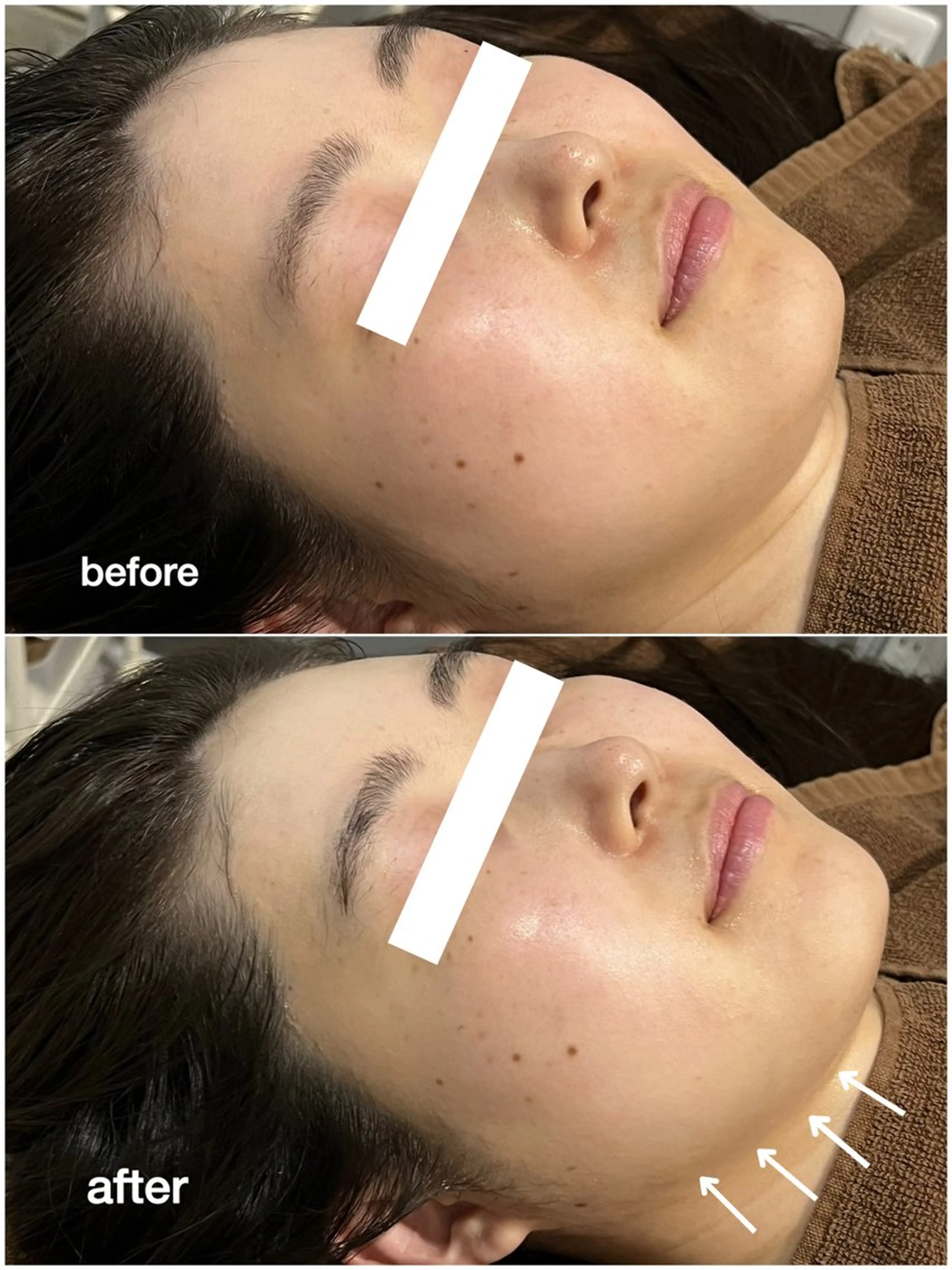 エステ ENCHANT Kaede/肌質改善のその他イメージ