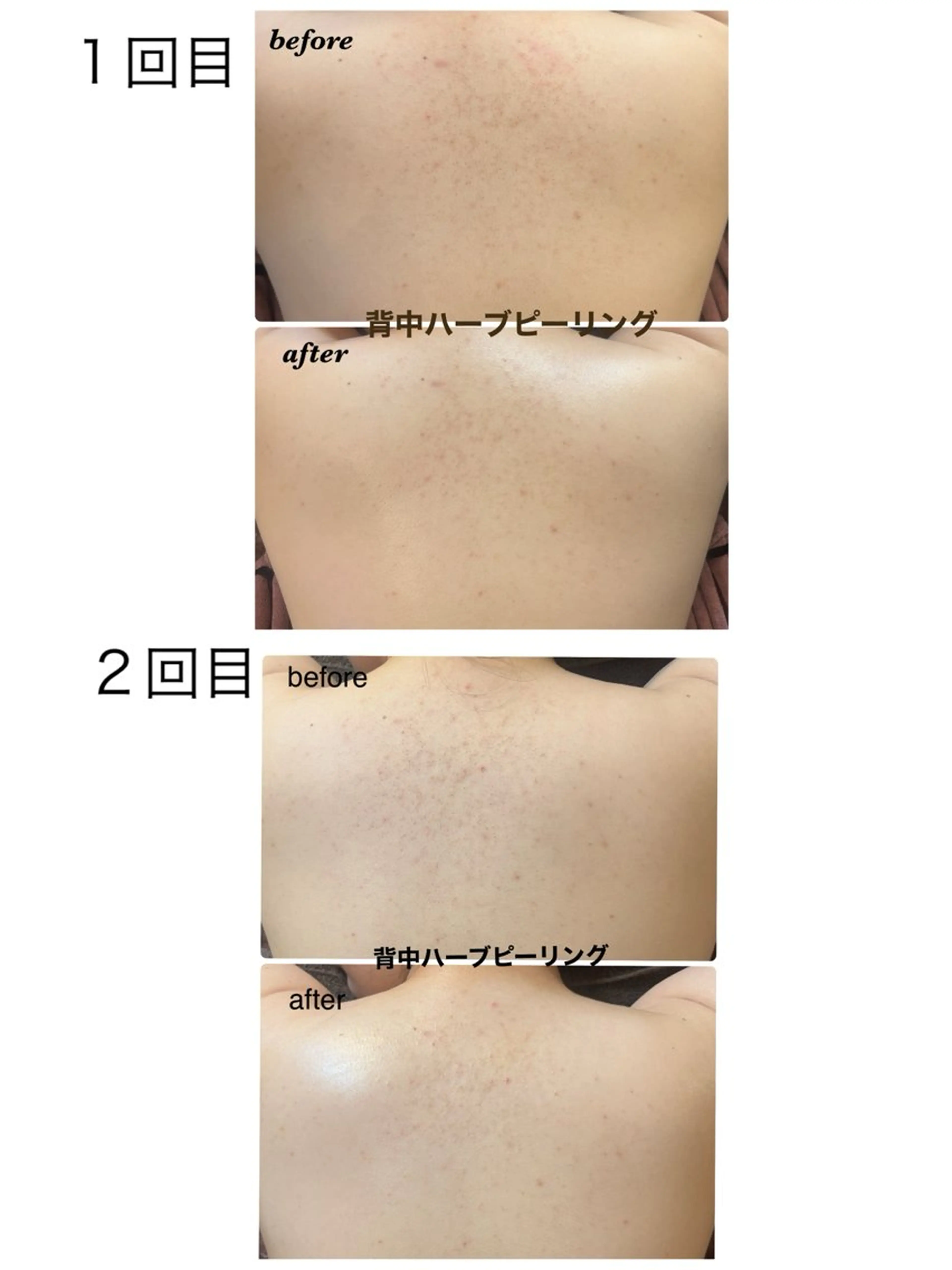 エステ ハーブピーリング専門 毛穴洗浄❤️眉waxのエステ・リラクイメージ