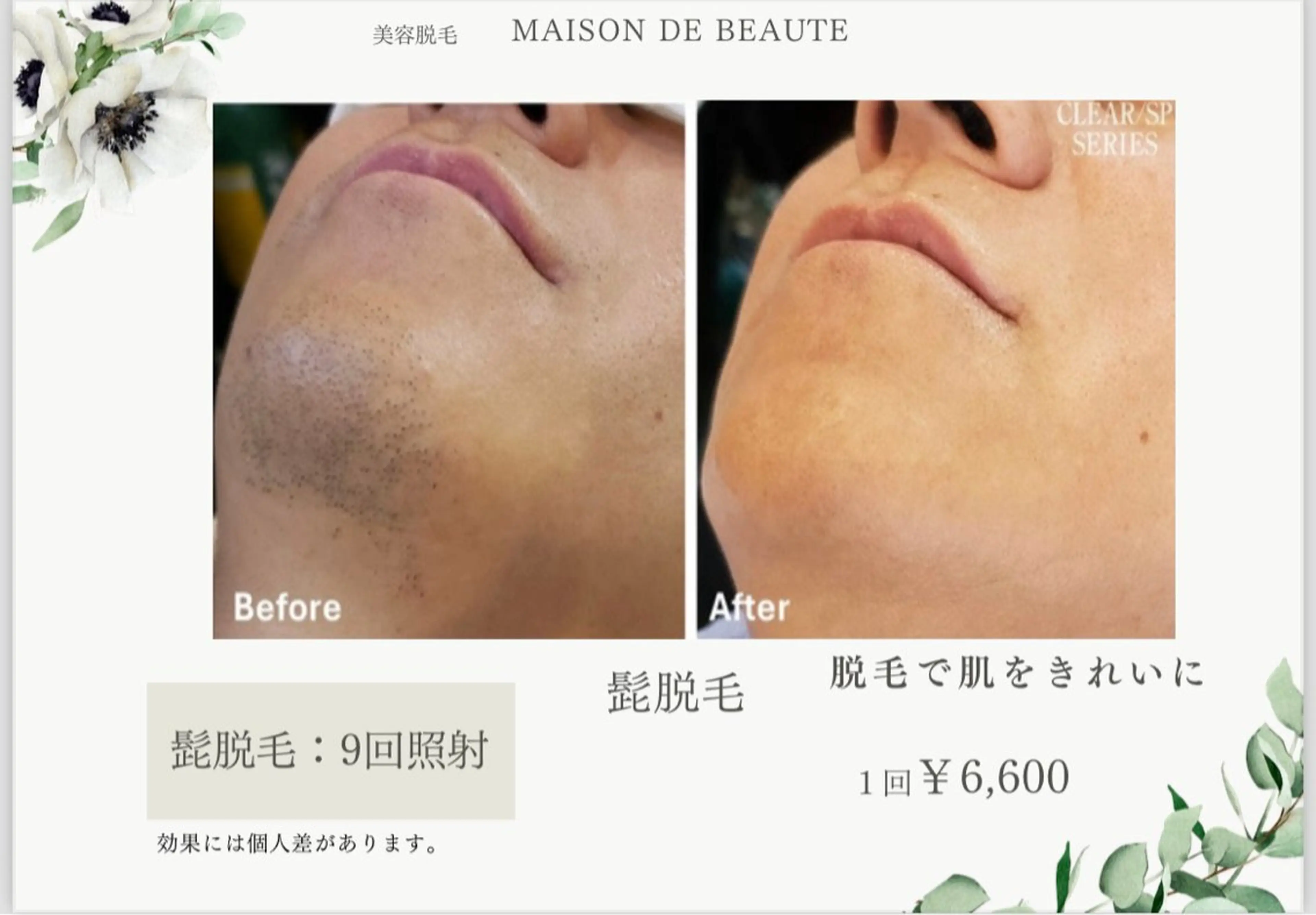 🖤ミニモ限定🥀　初回限定🧼💞ヒゲ脱毛🌟の写真