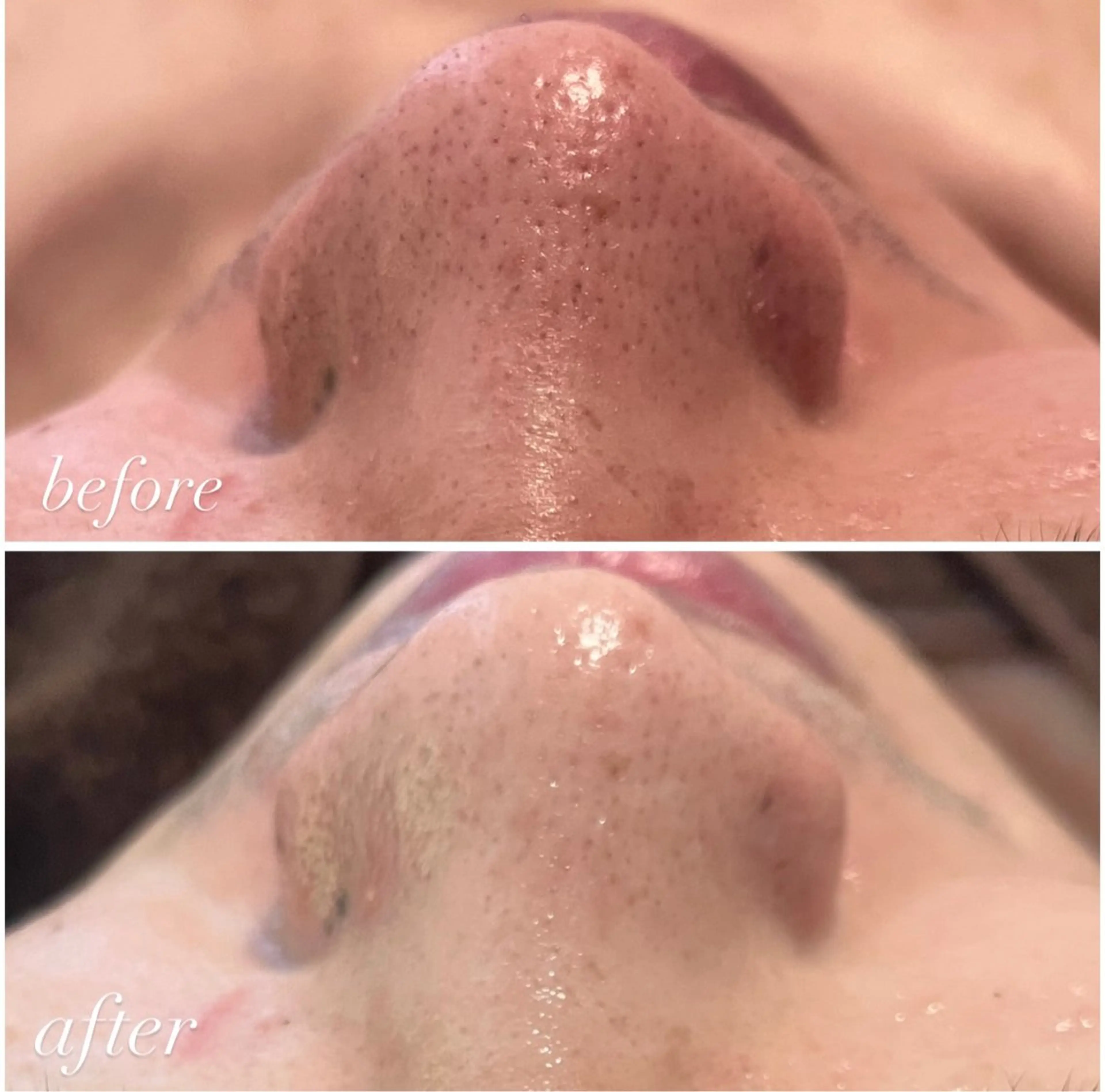 当店人気No.2メニュー✨️ 【 毛穴・美肌トーンupケア 】 REVIハーブピーリング🌿の写真