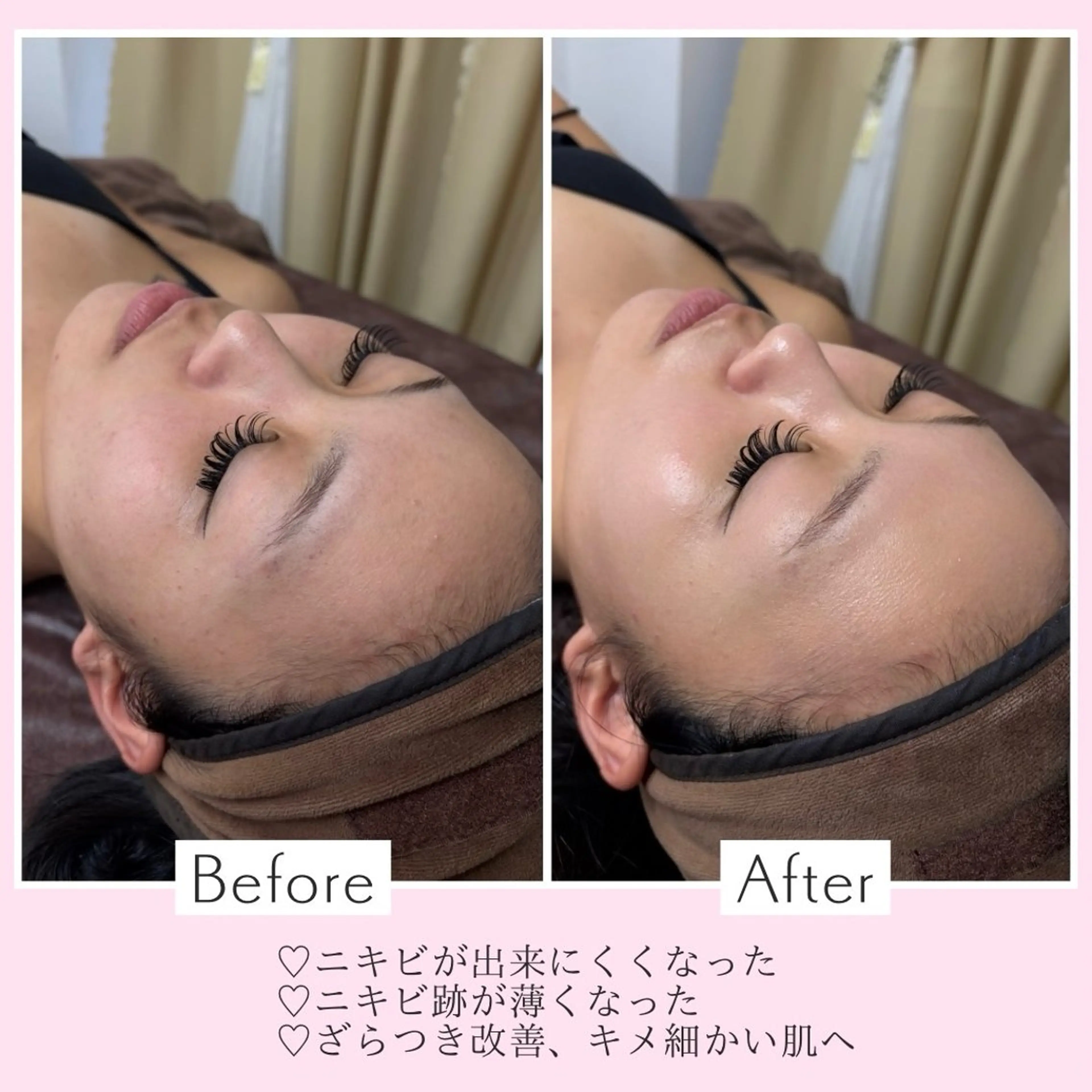 うるツヤ韓国ピーリング🇰🇷♡(剥離なし)の写真