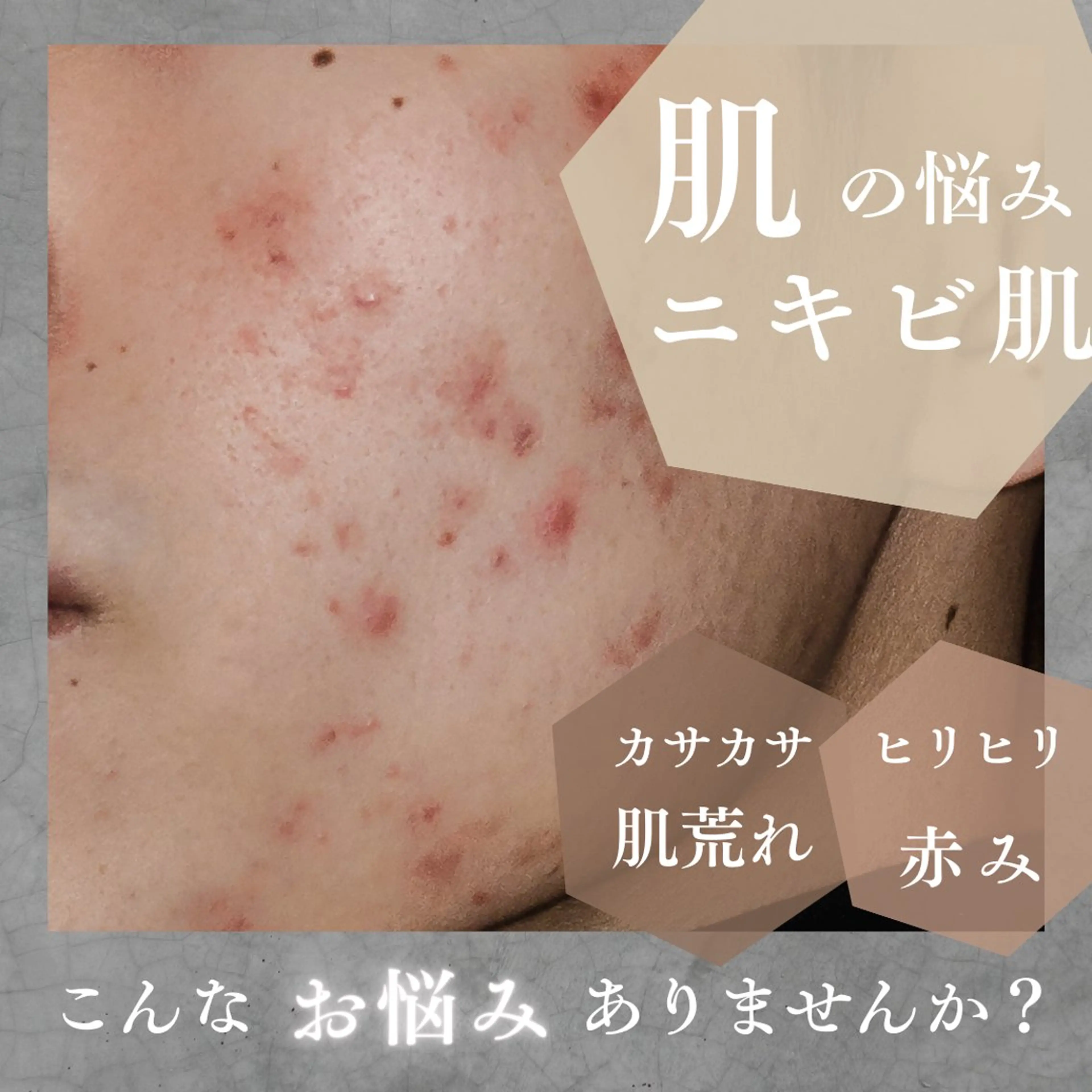 ハーブピーリングの写真