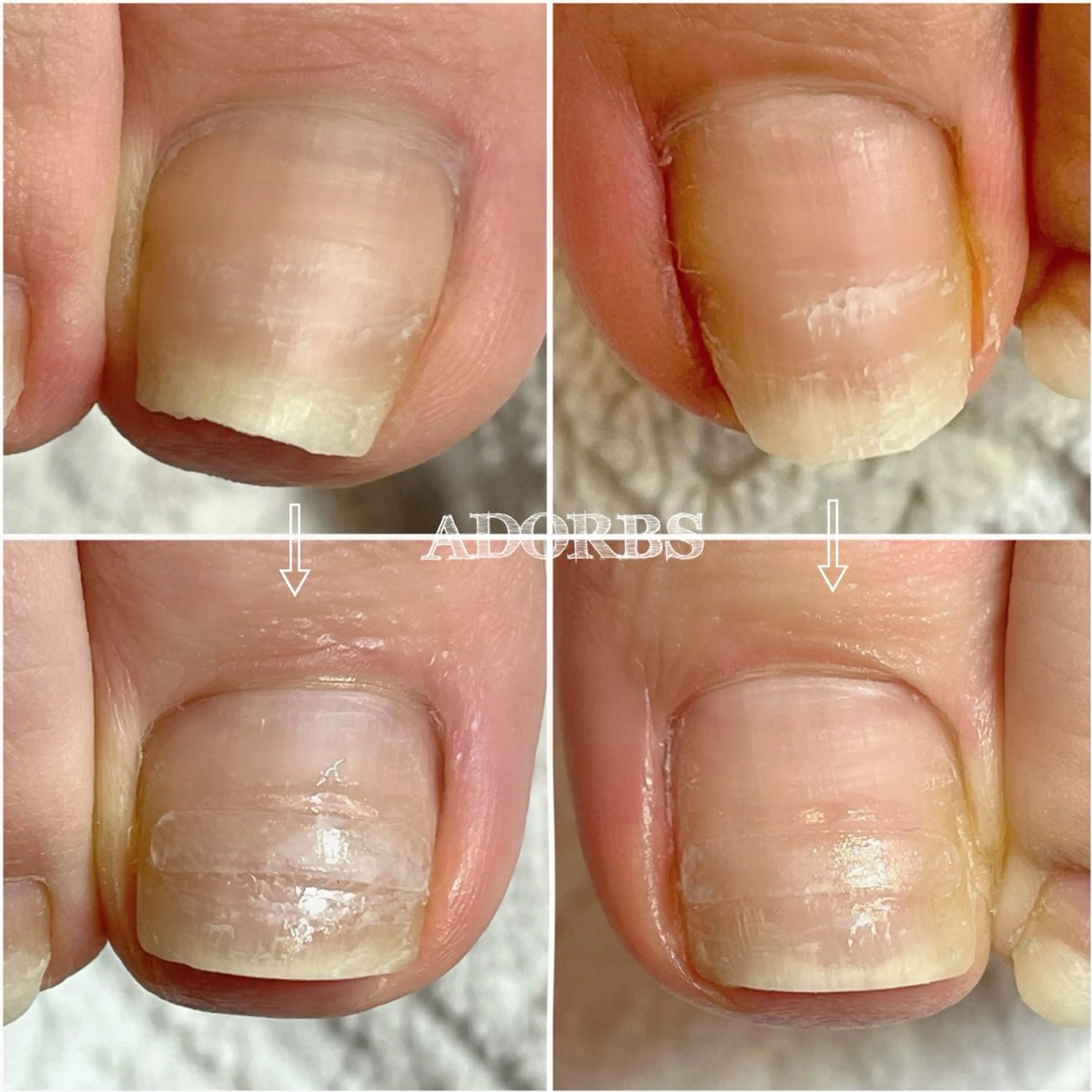 【ご新規様】【初回】巻き爪✴︎痛みのお悩み🦶足の巻き爪でお困りの方の写真