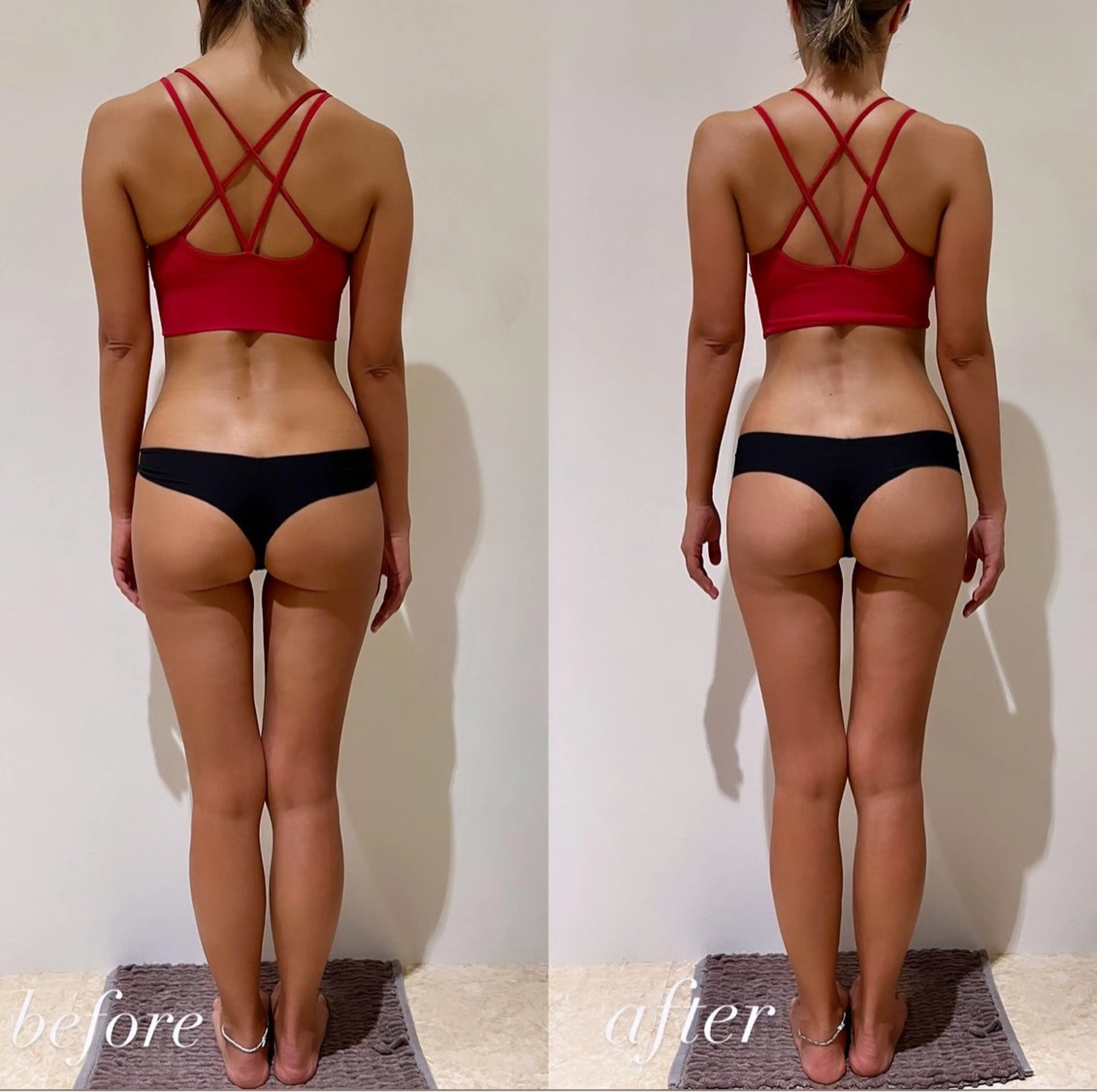 【足痩せ🦵🏻痩身ダイエットメニュー】ラジオ波キャビテーションで浮腫みを除去✨骨盤矯正/ヒップアップしたい方にオススメの写真