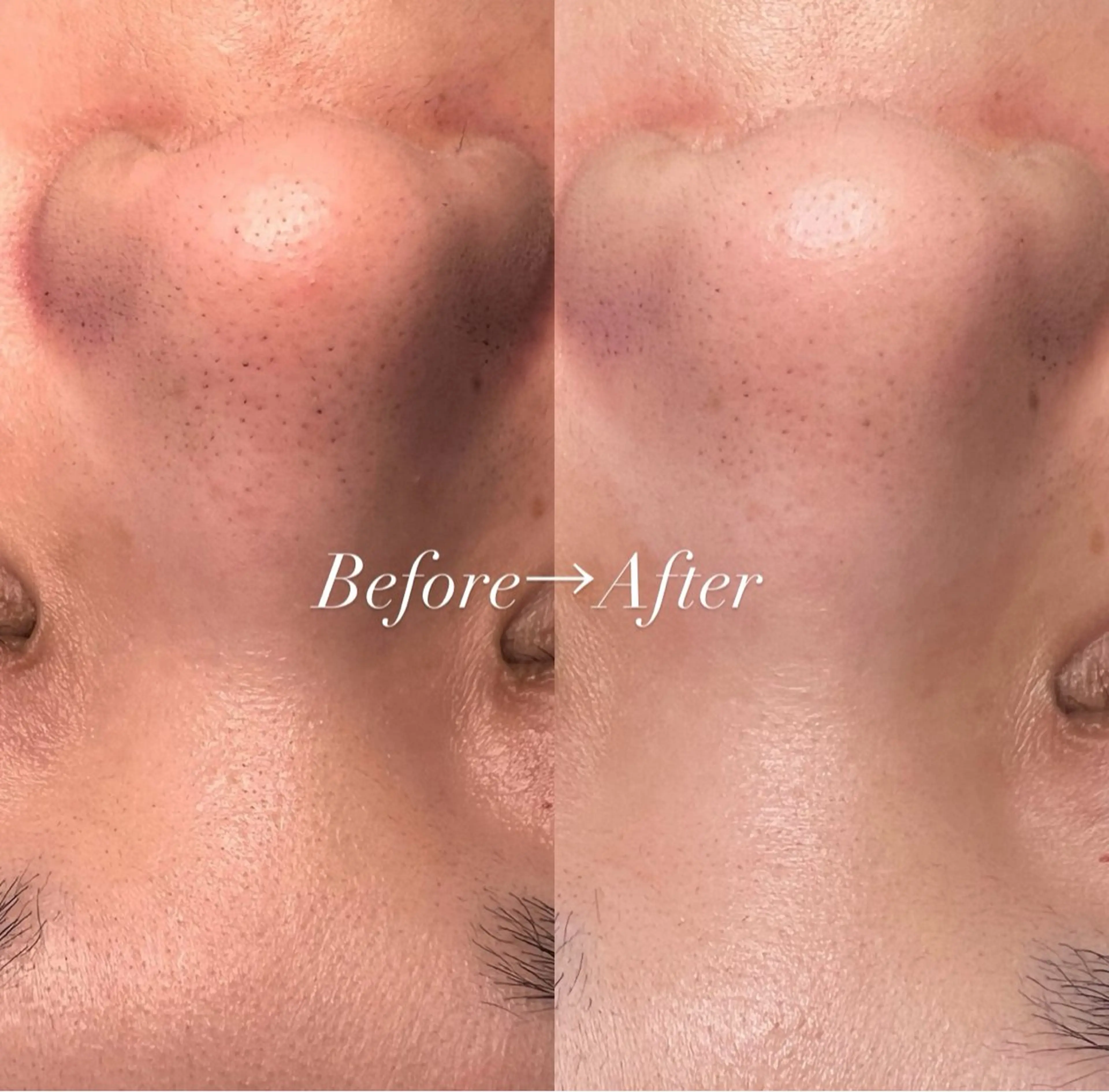 【ずっと同価格】ハイドラ毛穴洗浄✨毛穴詰まり/黒ずみ徹底ケア🎶¥3000の写真