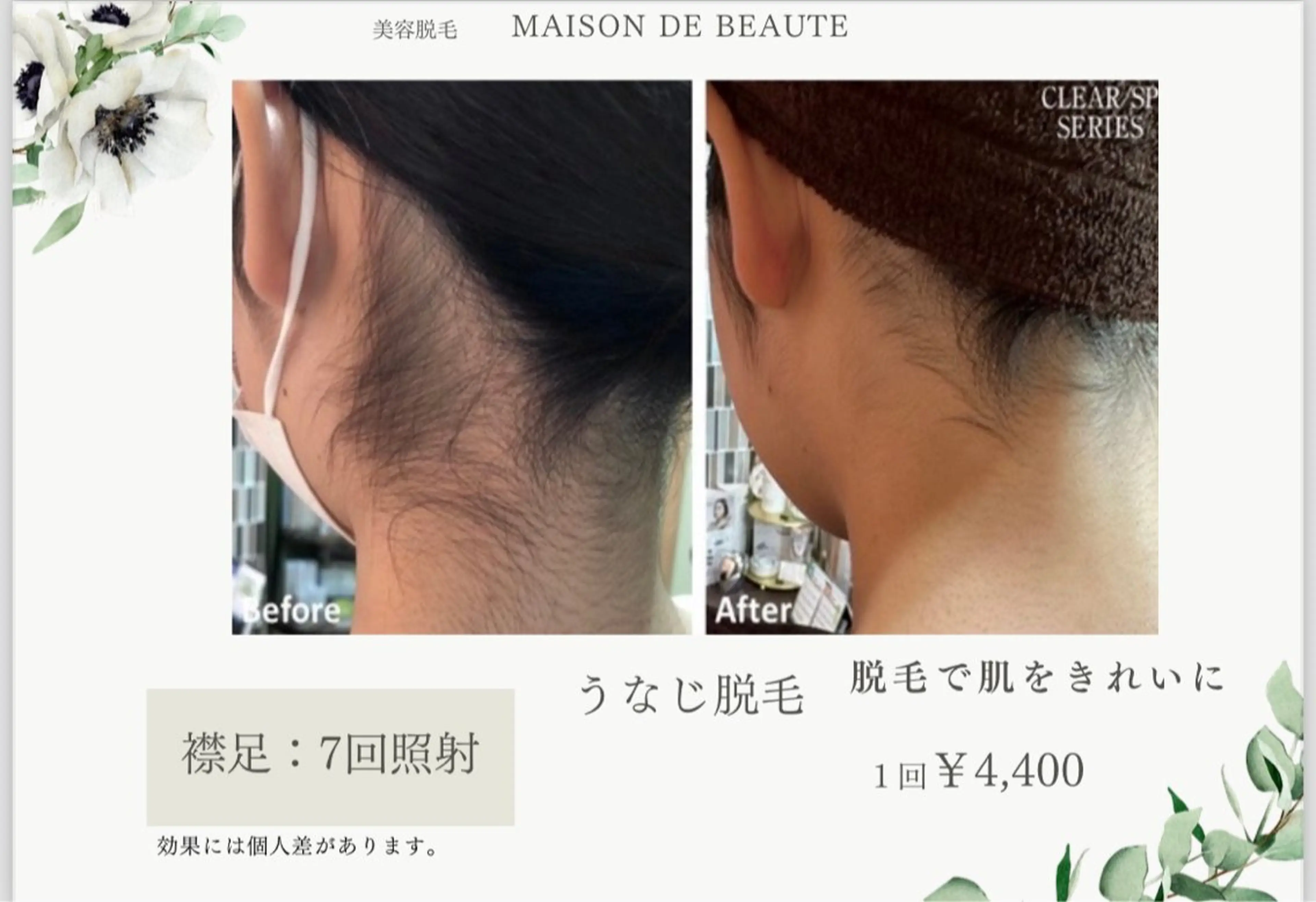 【🍉夏限定🌊】うなじ脱毛🌈🦴の写真