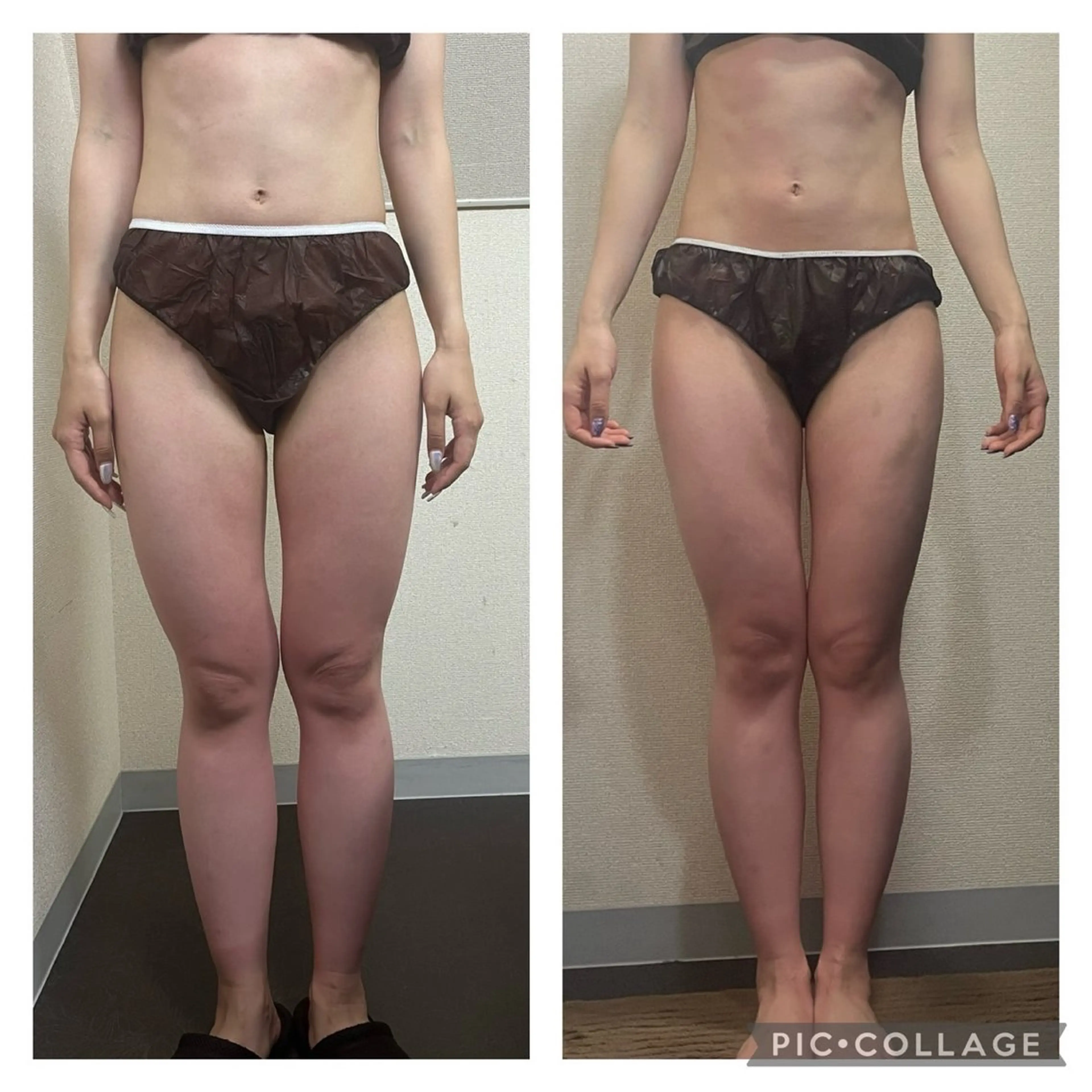 春夏に向けて👗即効痩せ✨《全身痩身ハイパーナイフ✖️強力デトックスマッサージ🔥》の写真