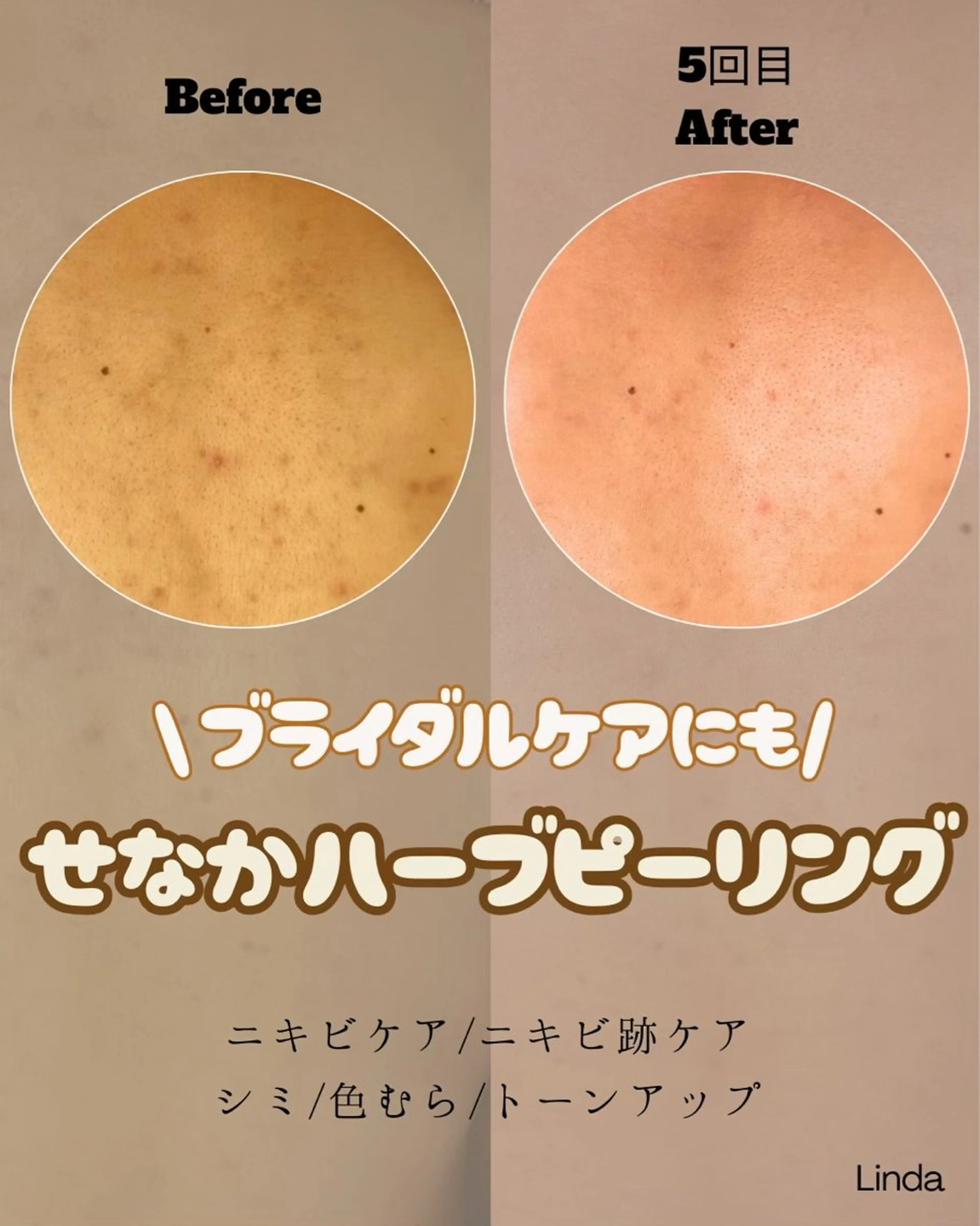 エステ 小顔&毛穴・肌質改善 LINDA西宮 AIのエステ・リラクイメージ