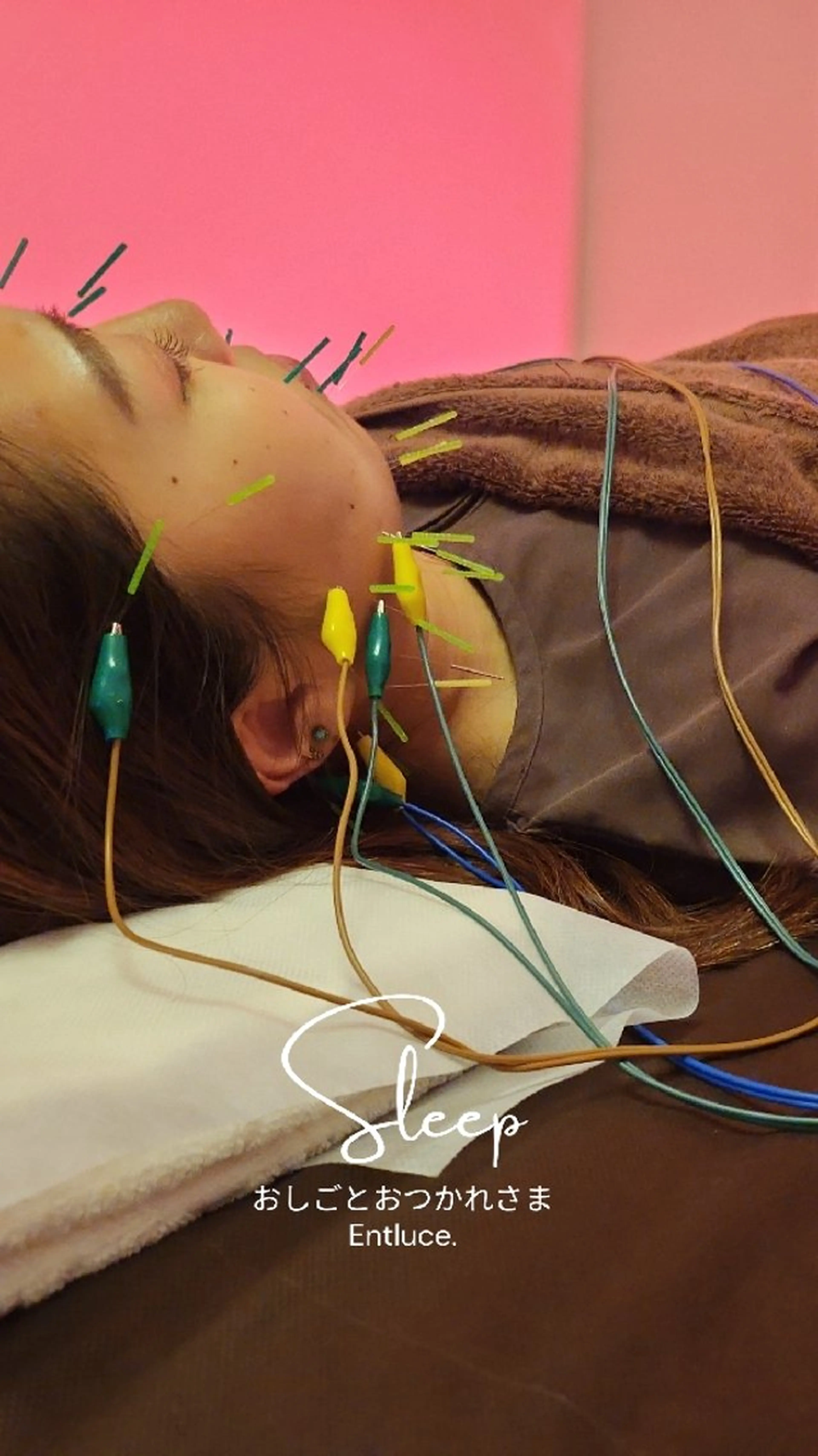 エステ リラク 即効⚡小顔美容鍼🪡 むくみたるみ脂肪解消のエステ・リラクイメージ