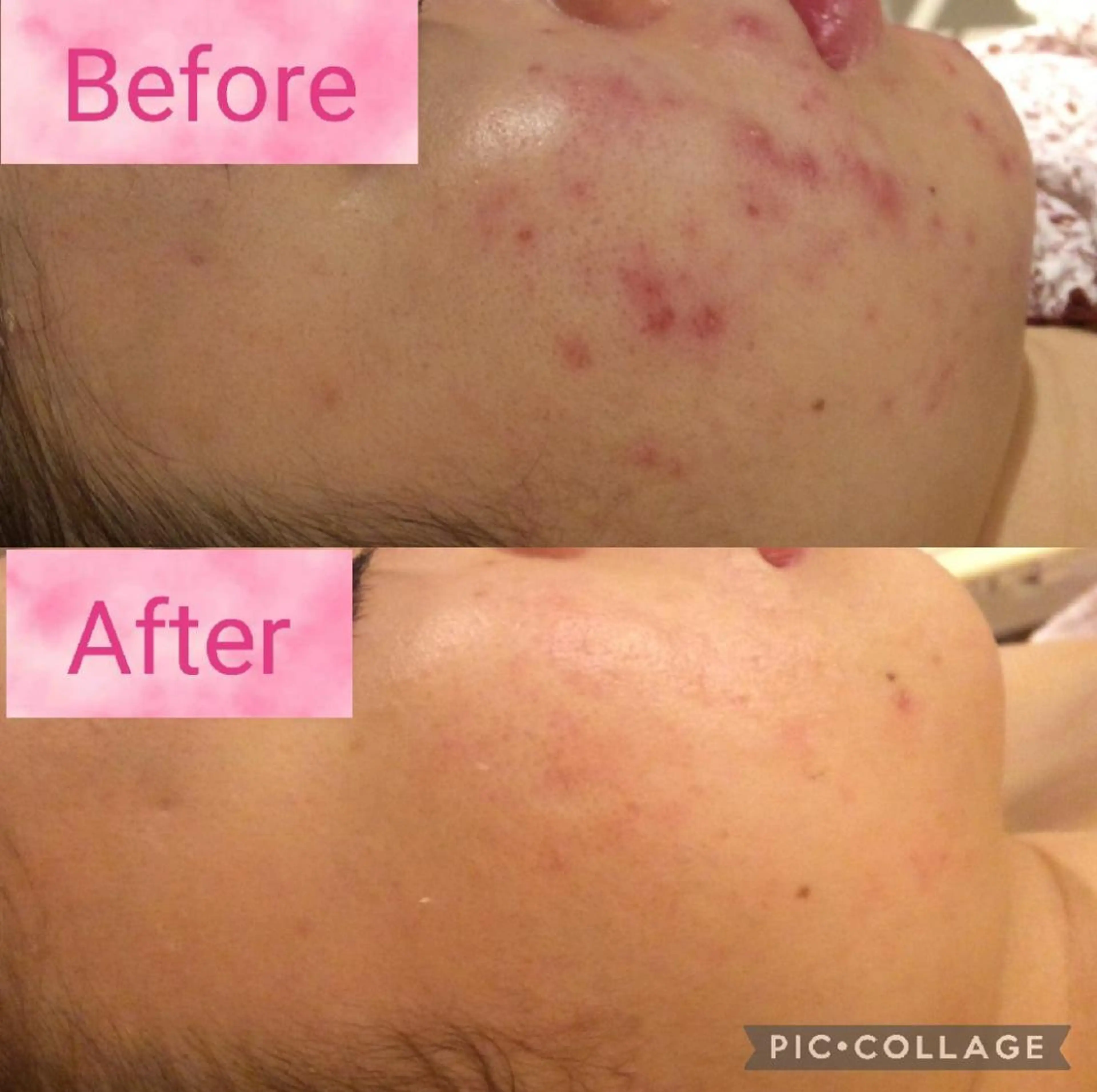 ニキビ跡改善専門🔥 医療にはできない改善のエステ・リラクイメージ