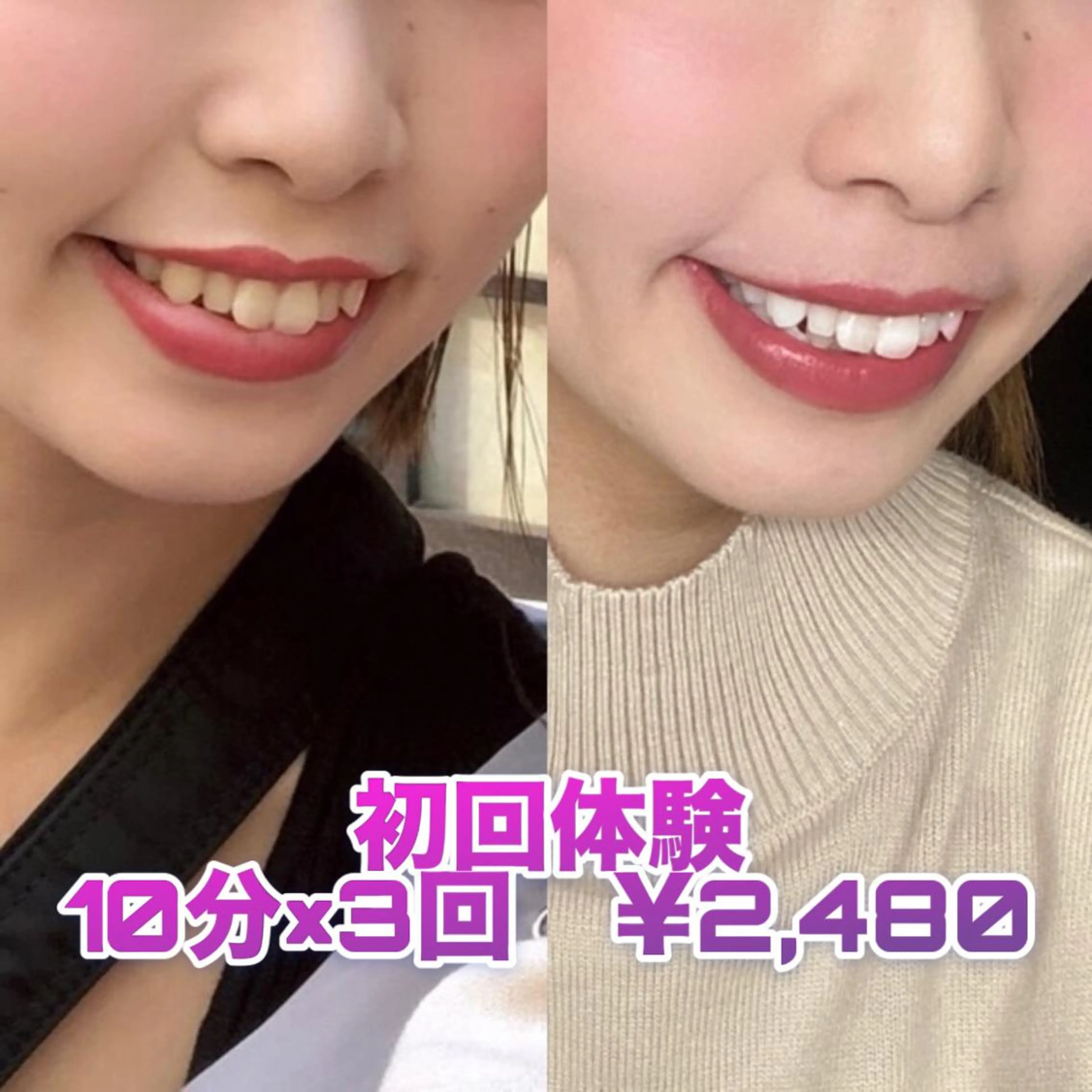 【1日3名様限定】💝初回体験💝セルフホワイトニング10分×3回​〜​安心のカウンセリング付き​〜​✨✨の写真