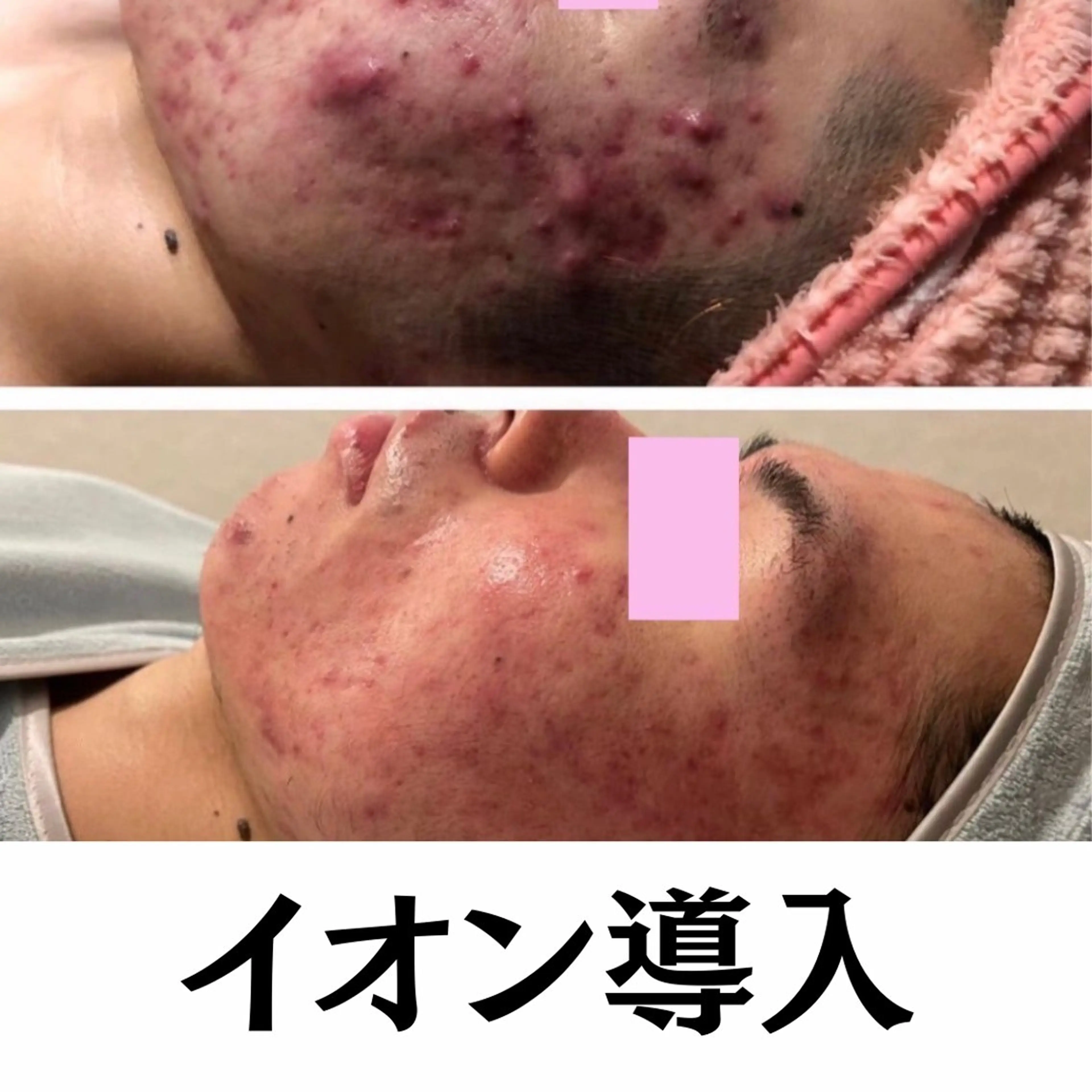 【新規/透明感爆上げ・春の毛穴ケア】全顔3D毛穴洗浄＋美容液うるおい浸透ケア¥12,200の写真