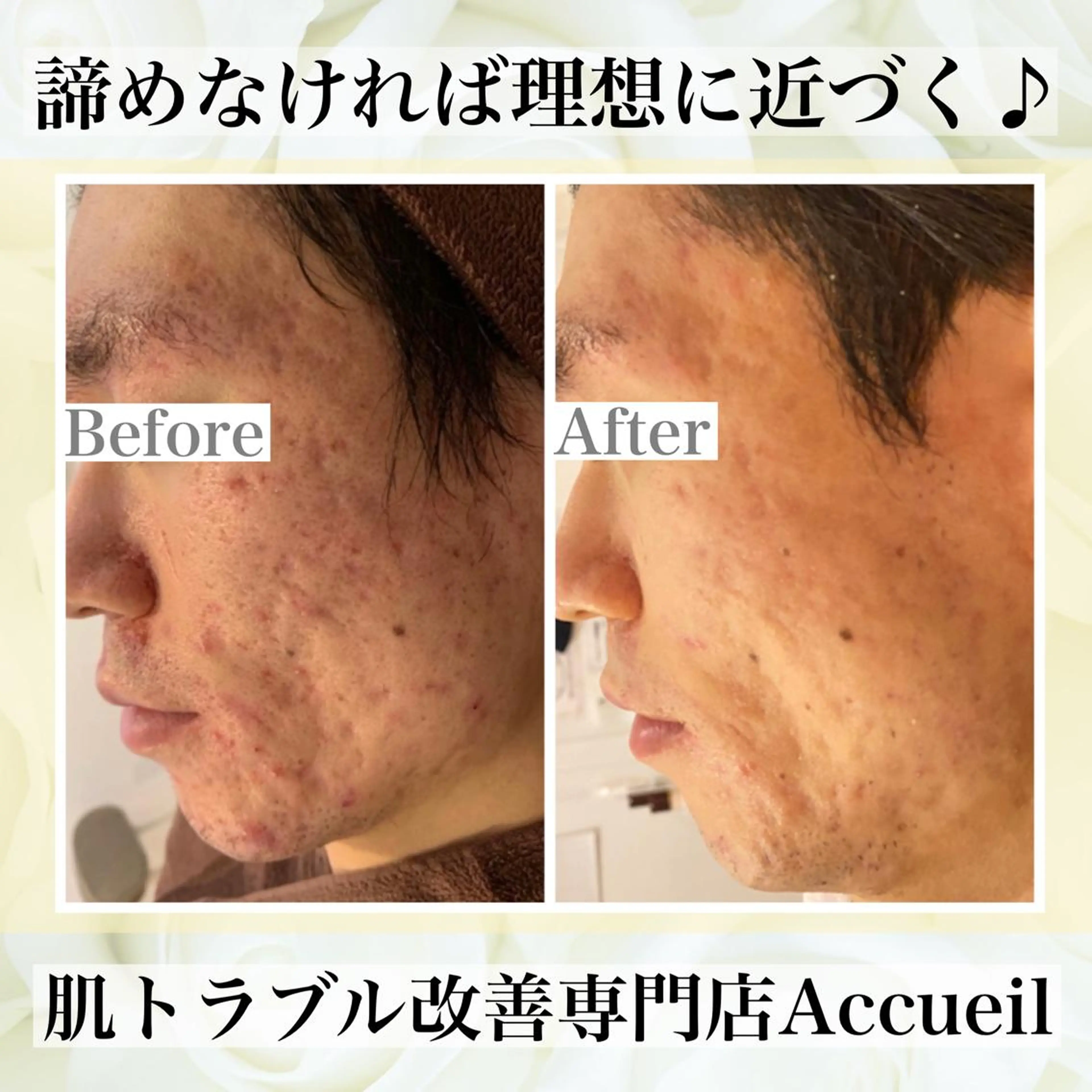 ミディアム カラー パーマ ヘアアレンジ メンズ キッズ ネイル マツエク・マツパ エステ リラク ニキビ・肌質改善専門 ♡人生が変わるサロンのエステ・リラクイメージ