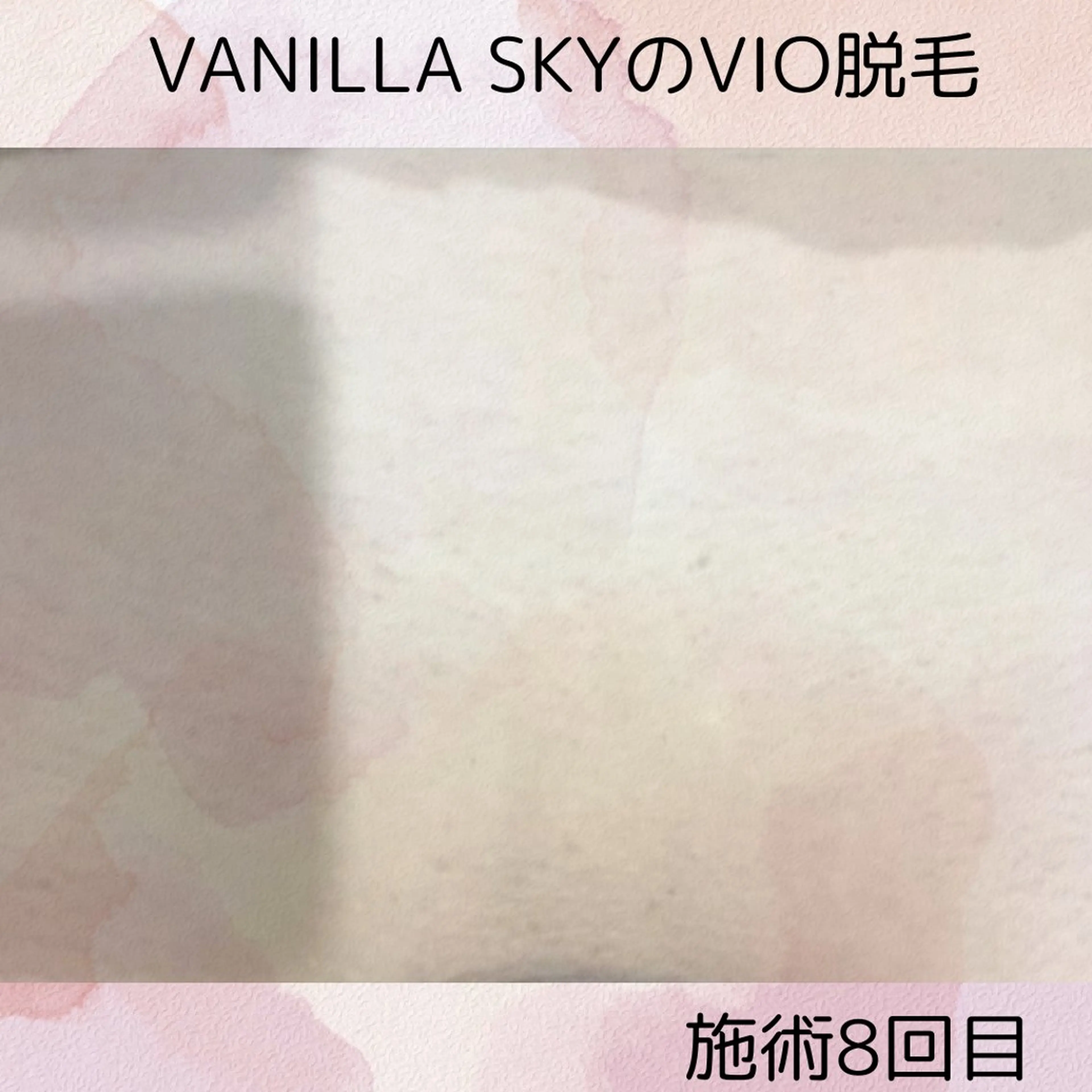 脱毛 VANILLA SKYのエステ・リラクイメージ