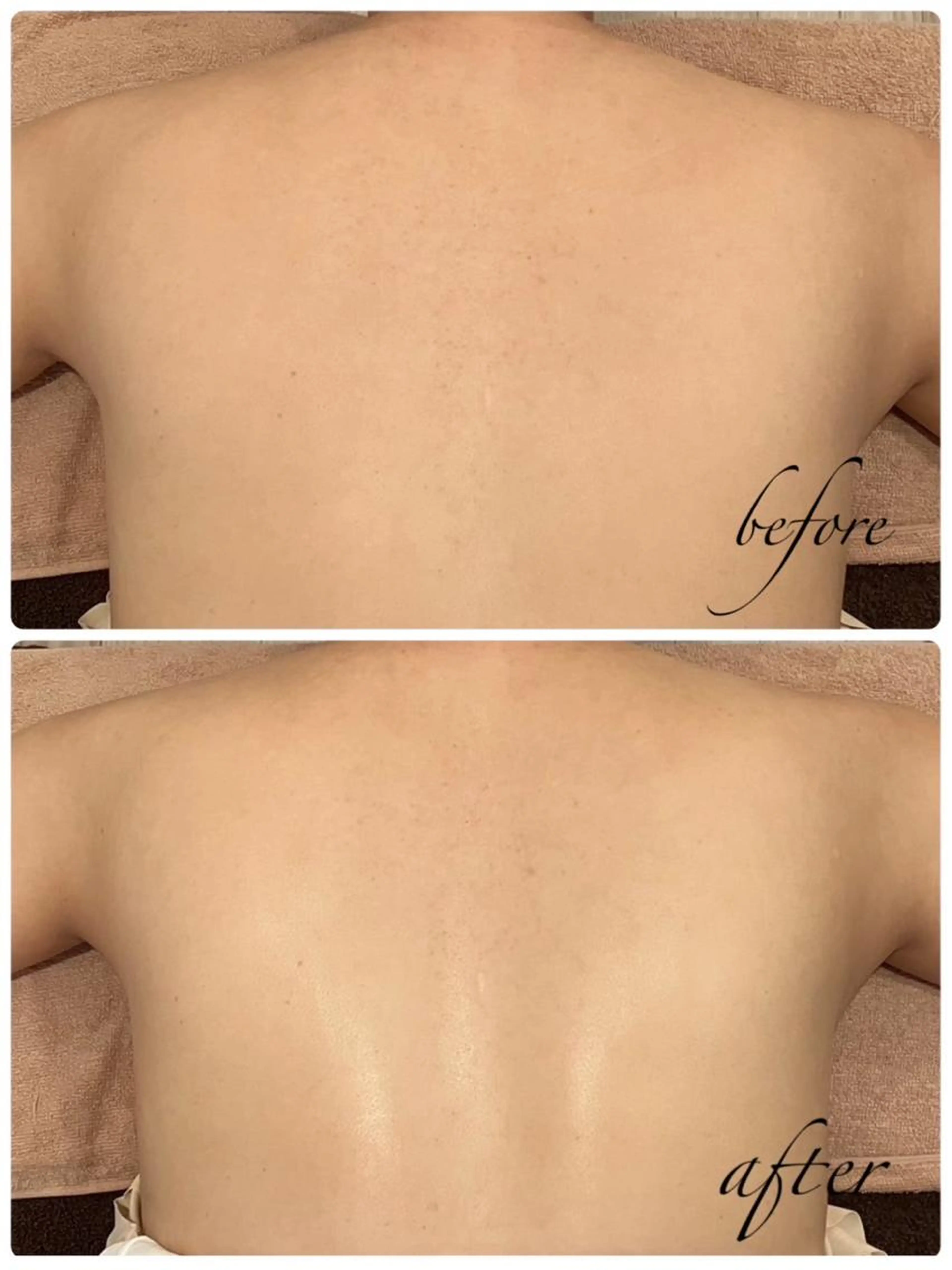 ⭐️ミニモ限定　背中オイルマッサージ付き⭐️脱離なし★背中ピーリング＆美白パック　背面美人コース50分　¥5500の写真