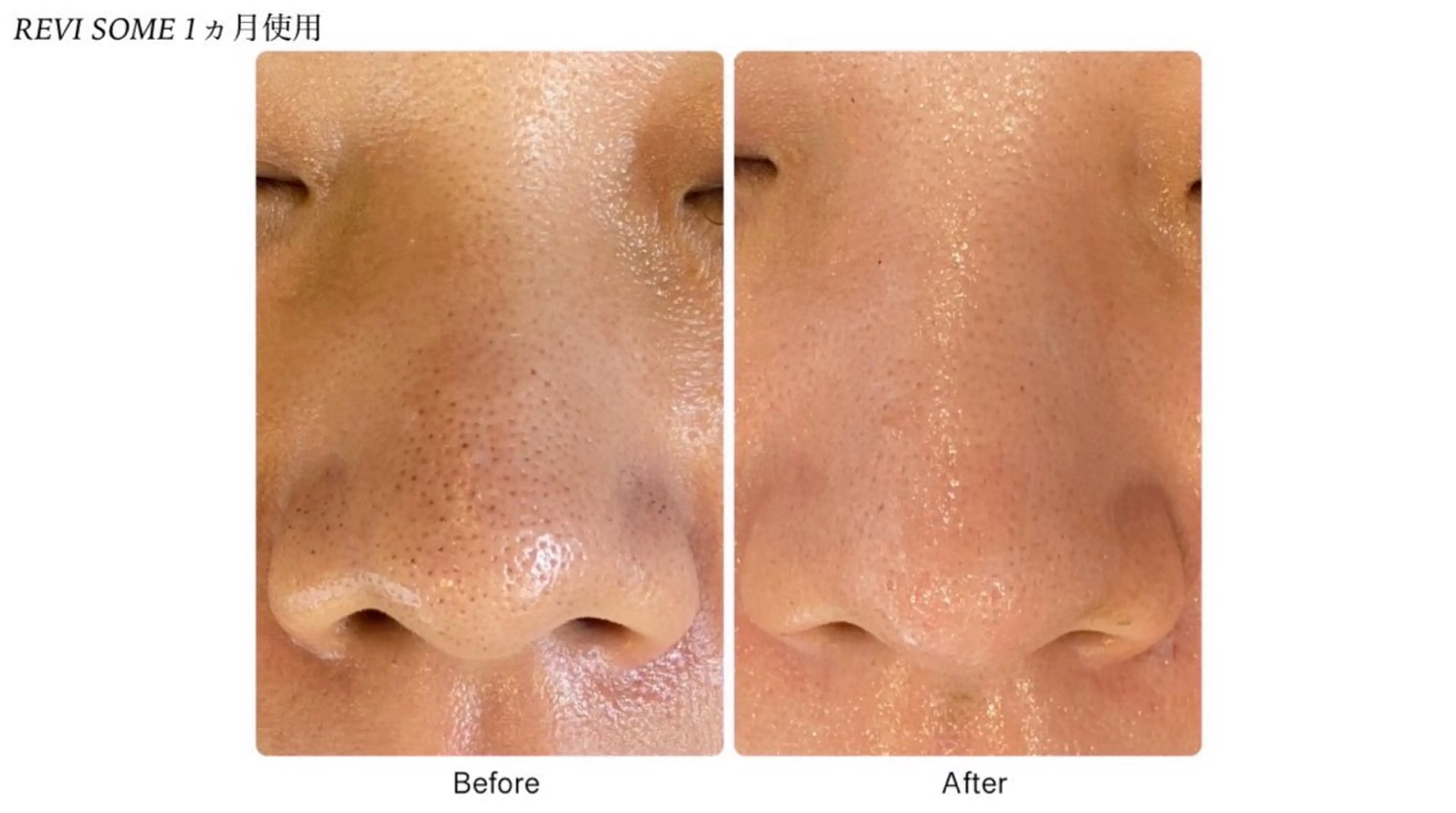 エステ 池袋ニキビ毛穴改善 🌿ハーブピーリングのエステ・リラクイメージ