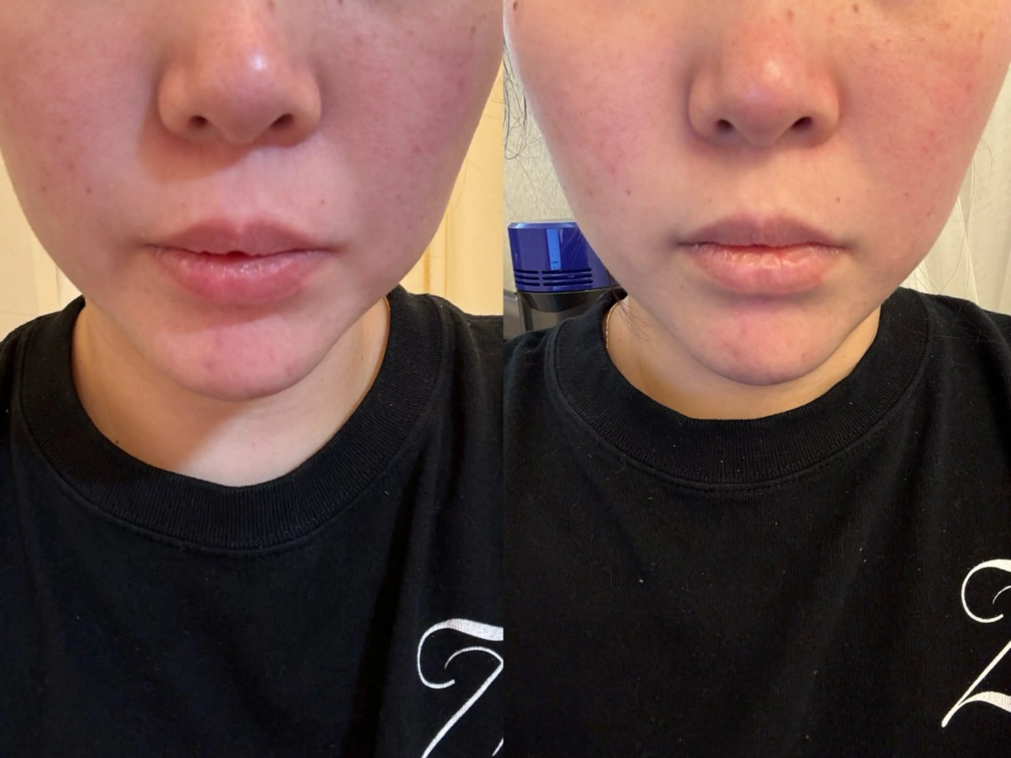 【見た目即-3kg】🍋ボトル進化版!脂肪減少エイジングケア『REDSHOT×プラズマ×LED』一部位¥7500の写真