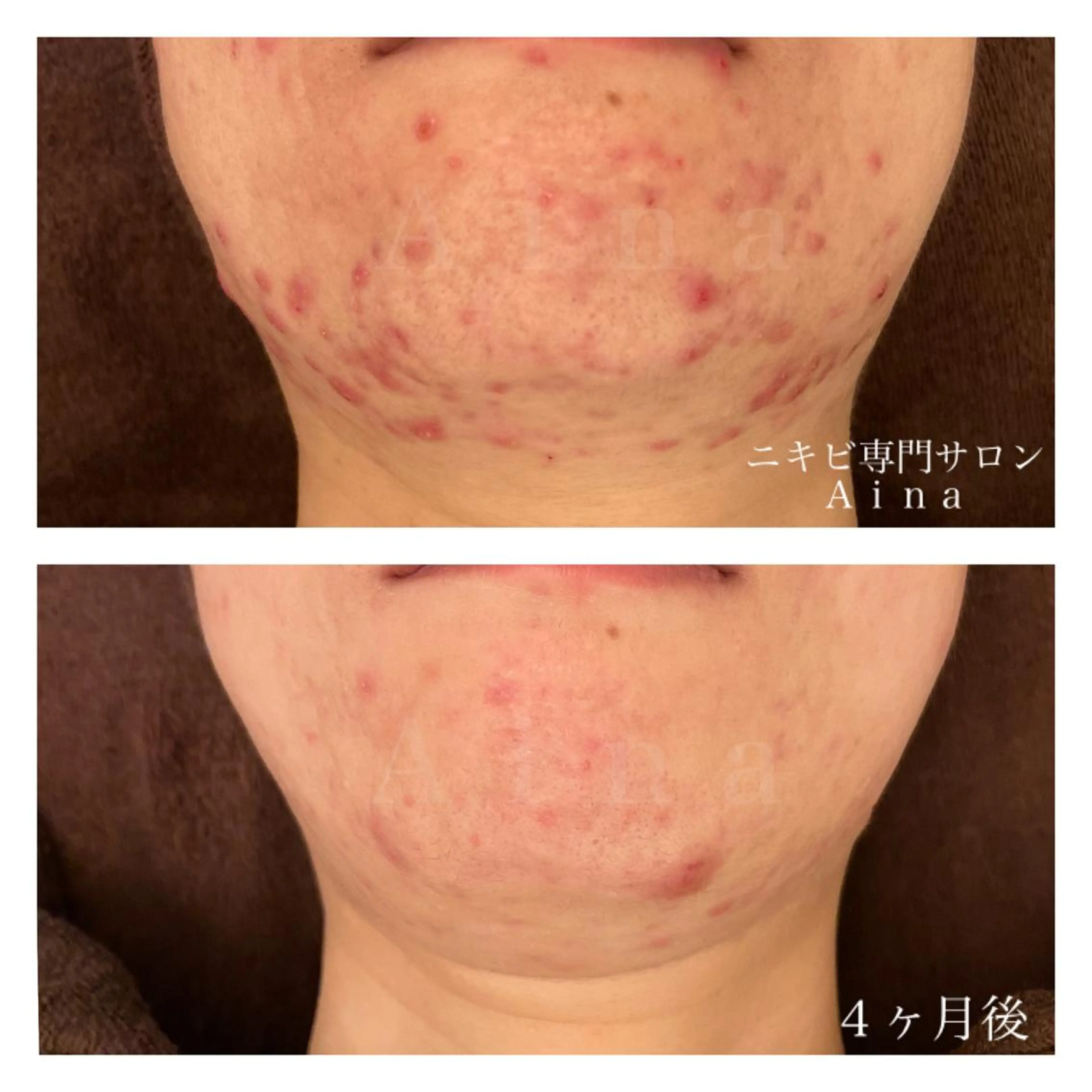 ミディアム カラー パーマ ヘアアレンジ メンズ キッズ ネイル マツエク・マツパ エステ リラク ニキビ跡専門サロン Ａｉｎａのエステ・リラクイメージ