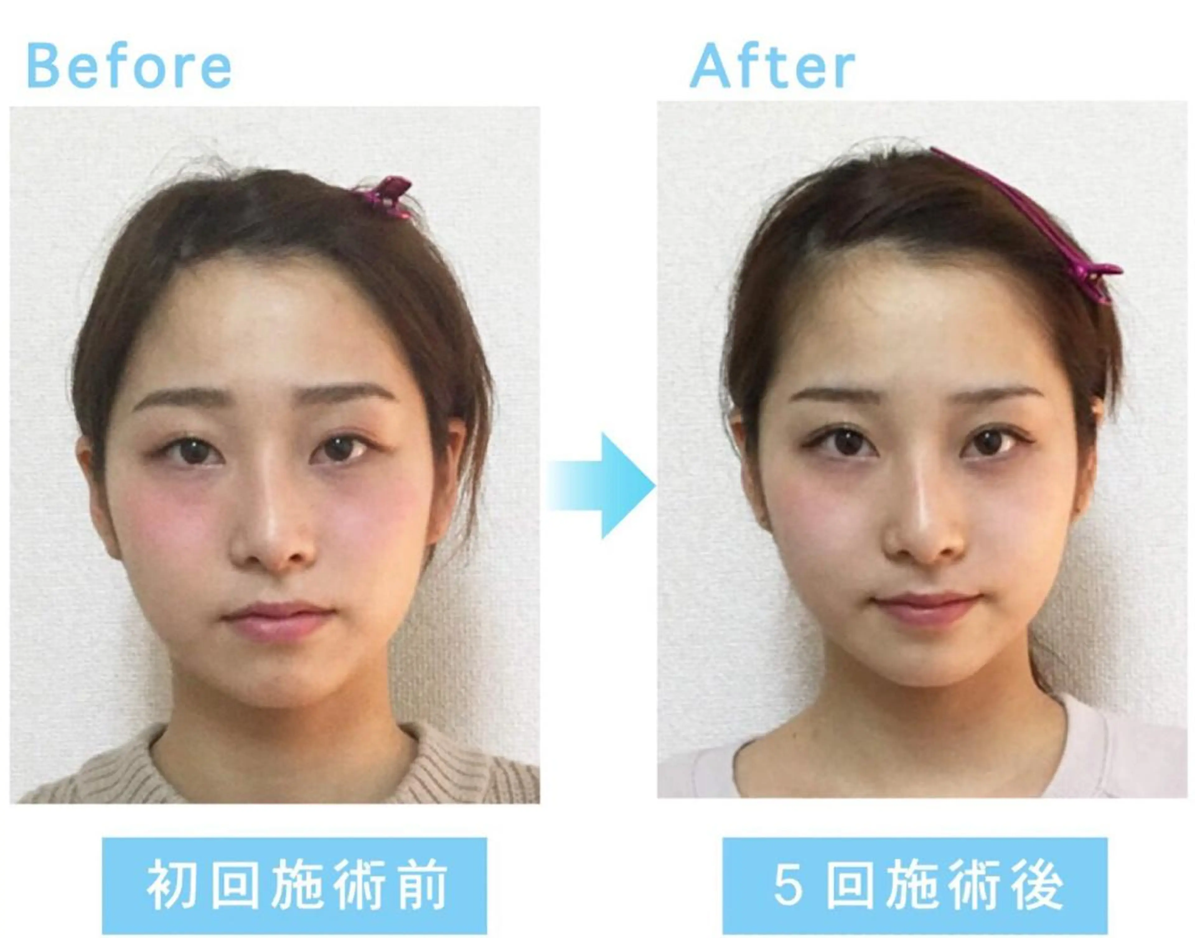 人気No.1💙本場韓国式 小顔コルギ 即実感◎ 90分の写真