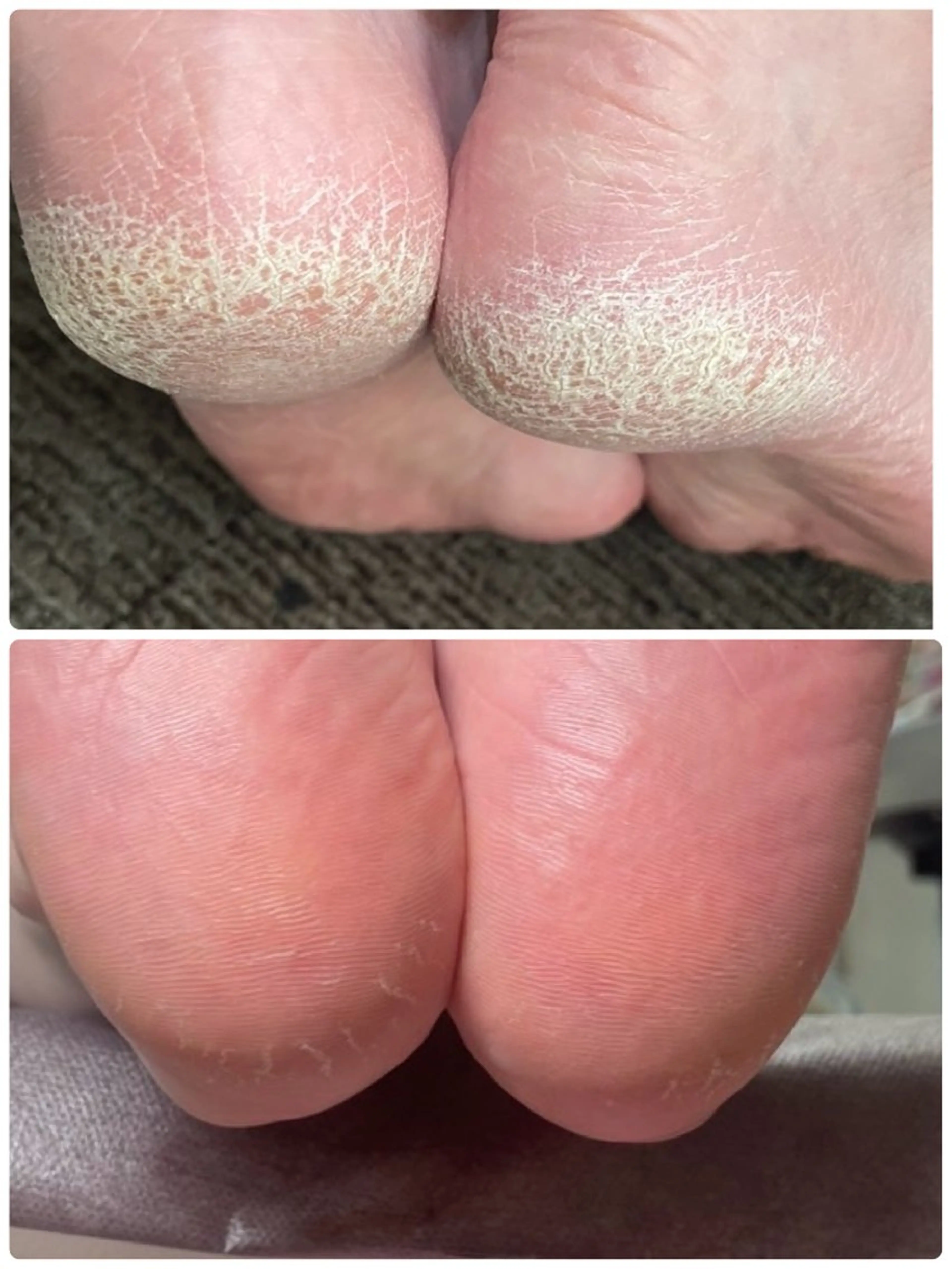 (土日祝)フットバス・爪切り・爪周り＆角質ケア・たこ＆魚の目ケア・巻き爪ケア (ジェル・ポリッシュなし)の写真