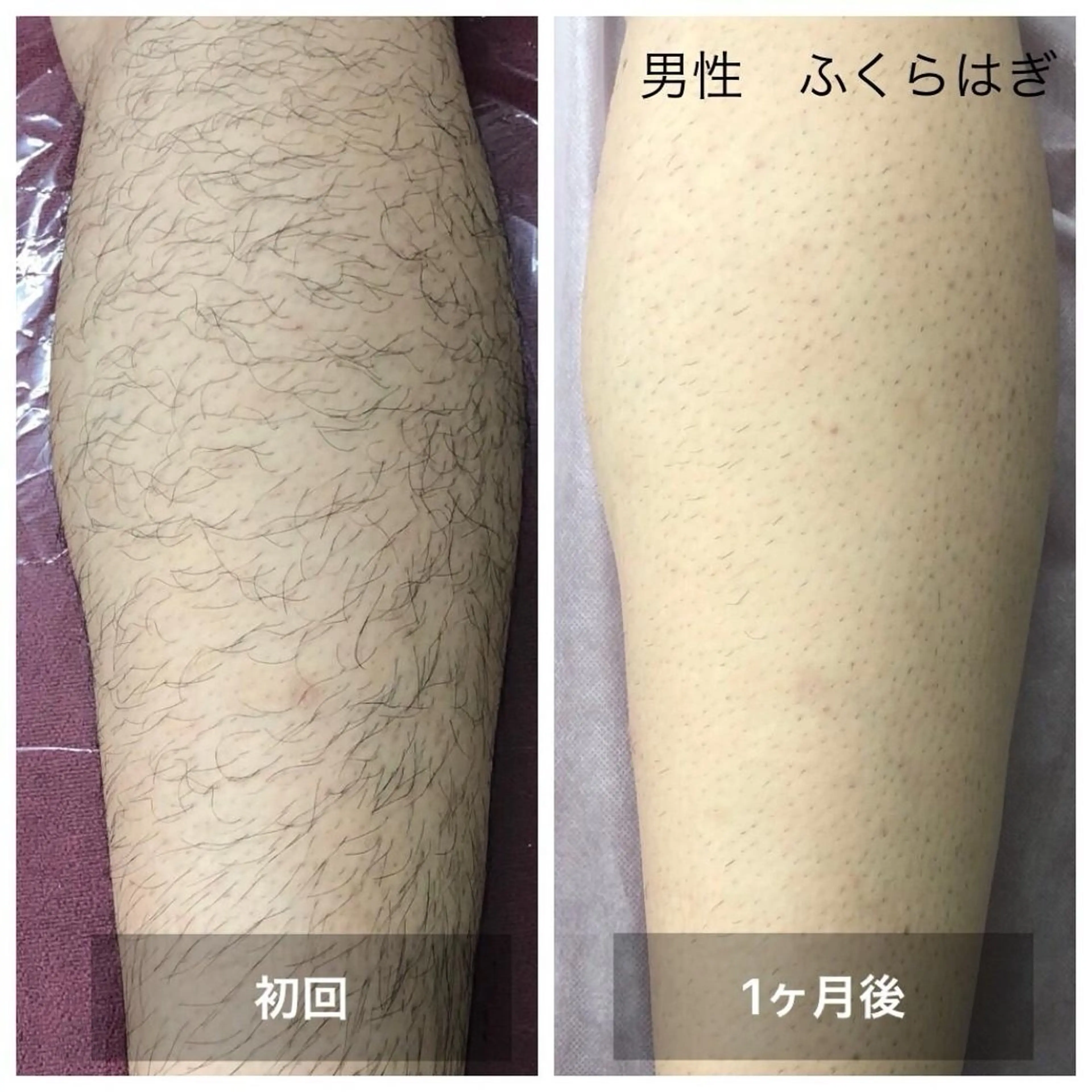 脱毛　Beauty salon Lumiere（ルミエール）所属・完全都度払い脱毛⭐︎ Lumiereのエステ・リラクイメージ