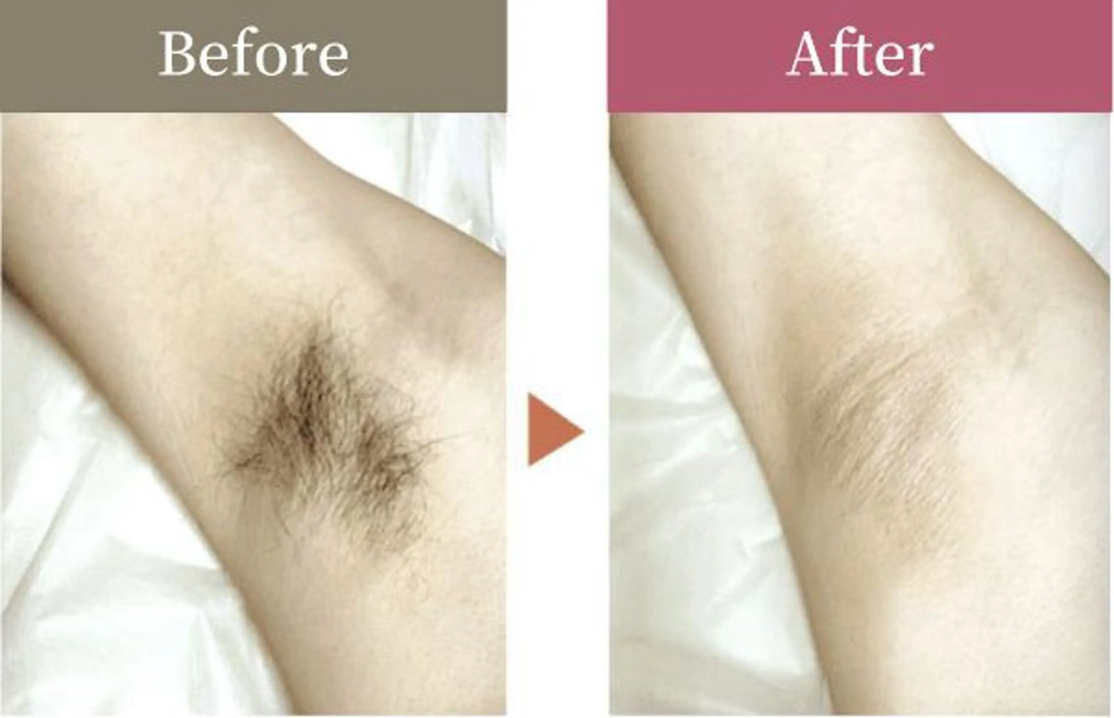 脱毛 エステサロンスマイリー所属・ｴｽﾃｻﾛﾝ ｽﾏｲﾘｰ後藤理恵のエステ・リラクイメージ