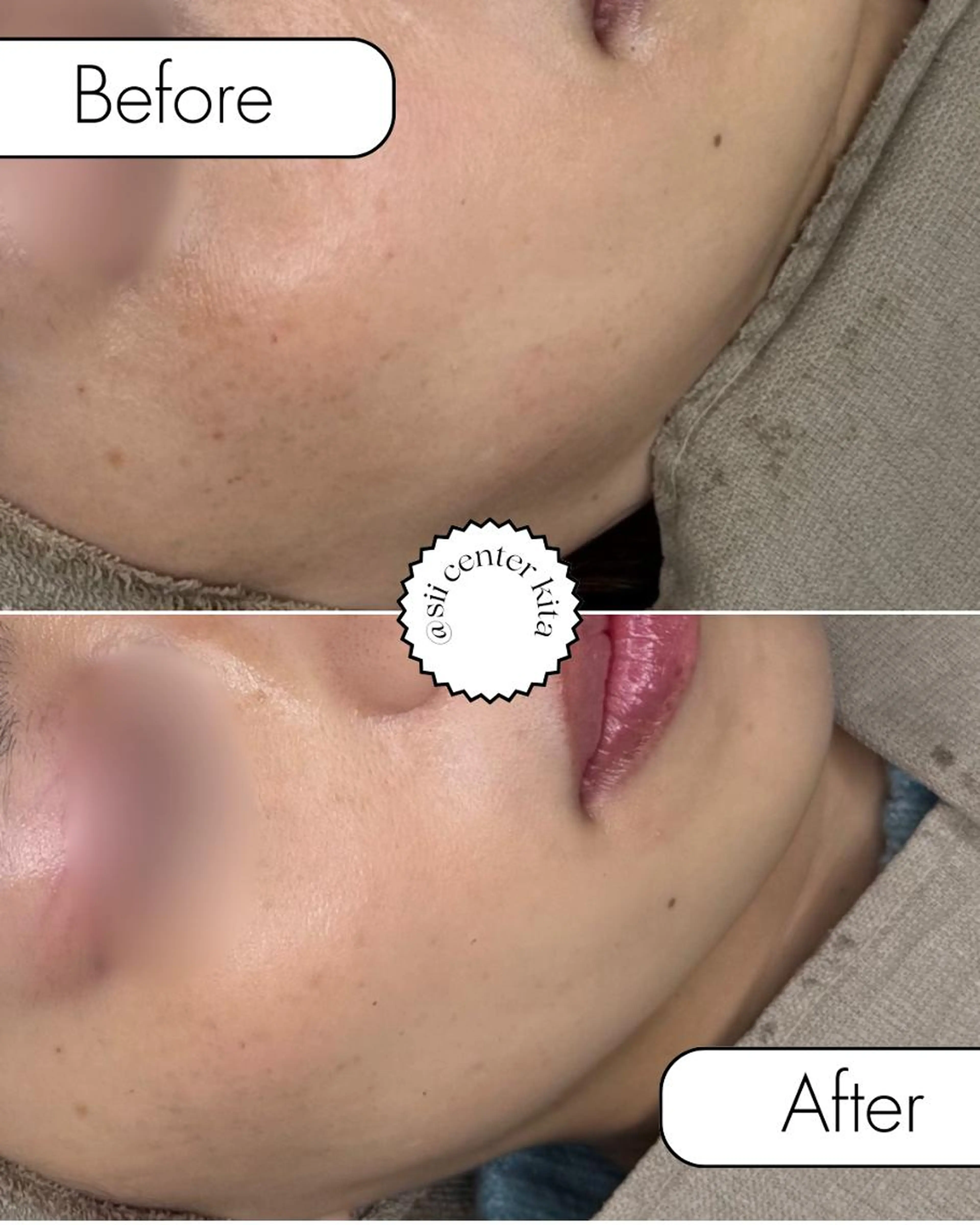 光シャワーフォト美顔＋水素マスク💫\14300→￥3300の写真