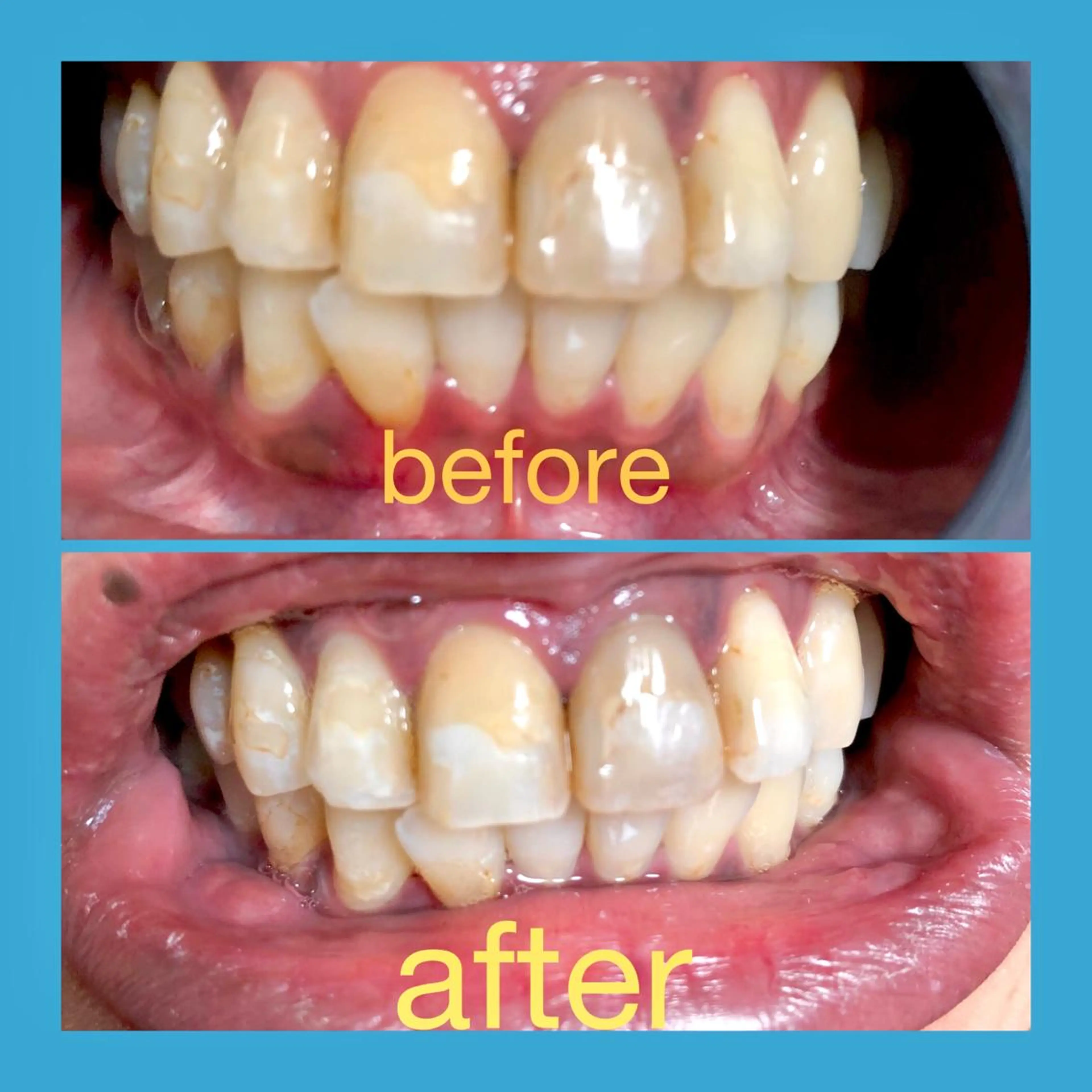 ネイル アートネイル フットネイル ハート ニュアンスネイル ホワイト その他 two nailのネイルデザイン