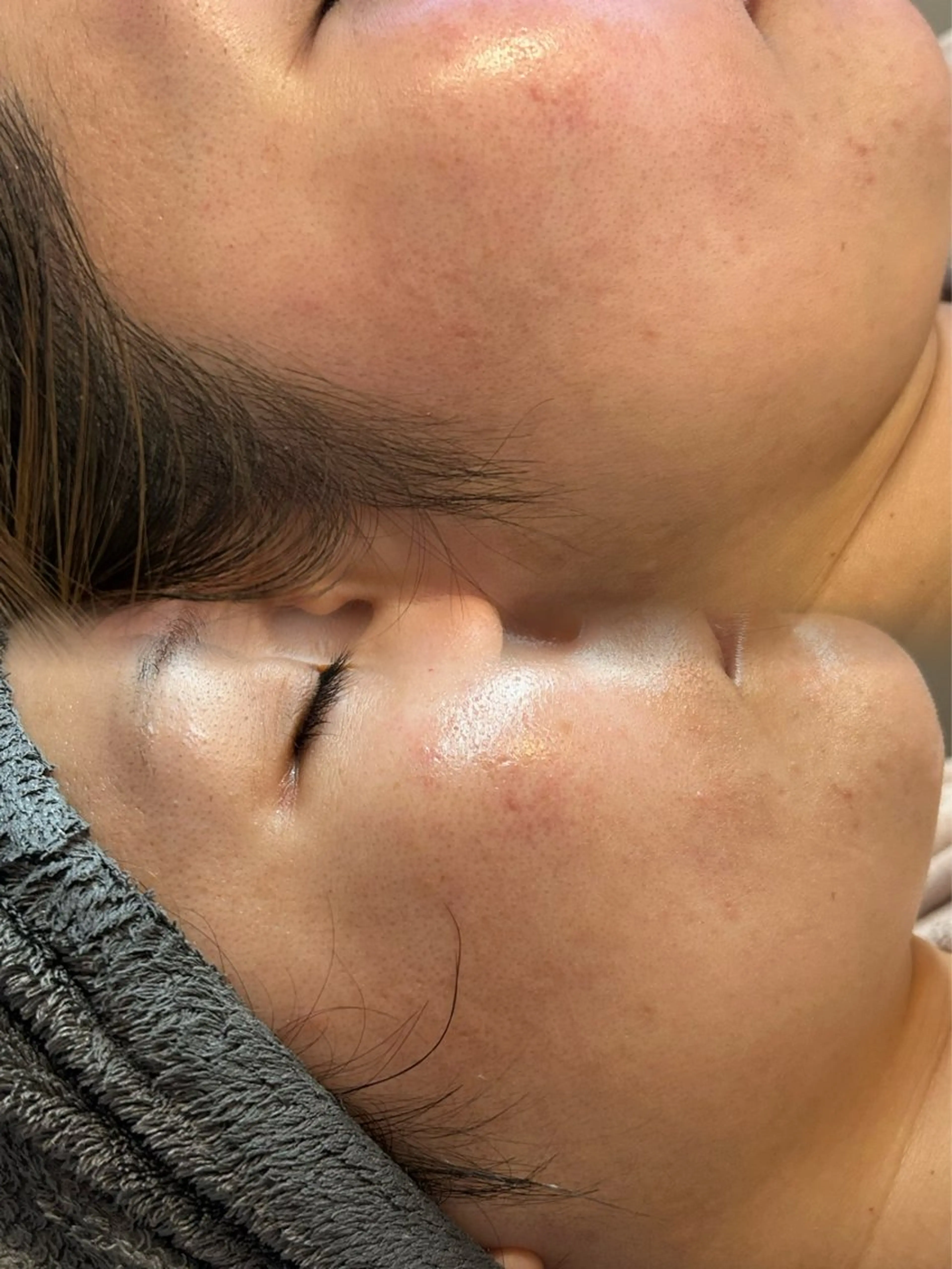 韓国人気No. 1 ララピール第4世代ピーリングの写真