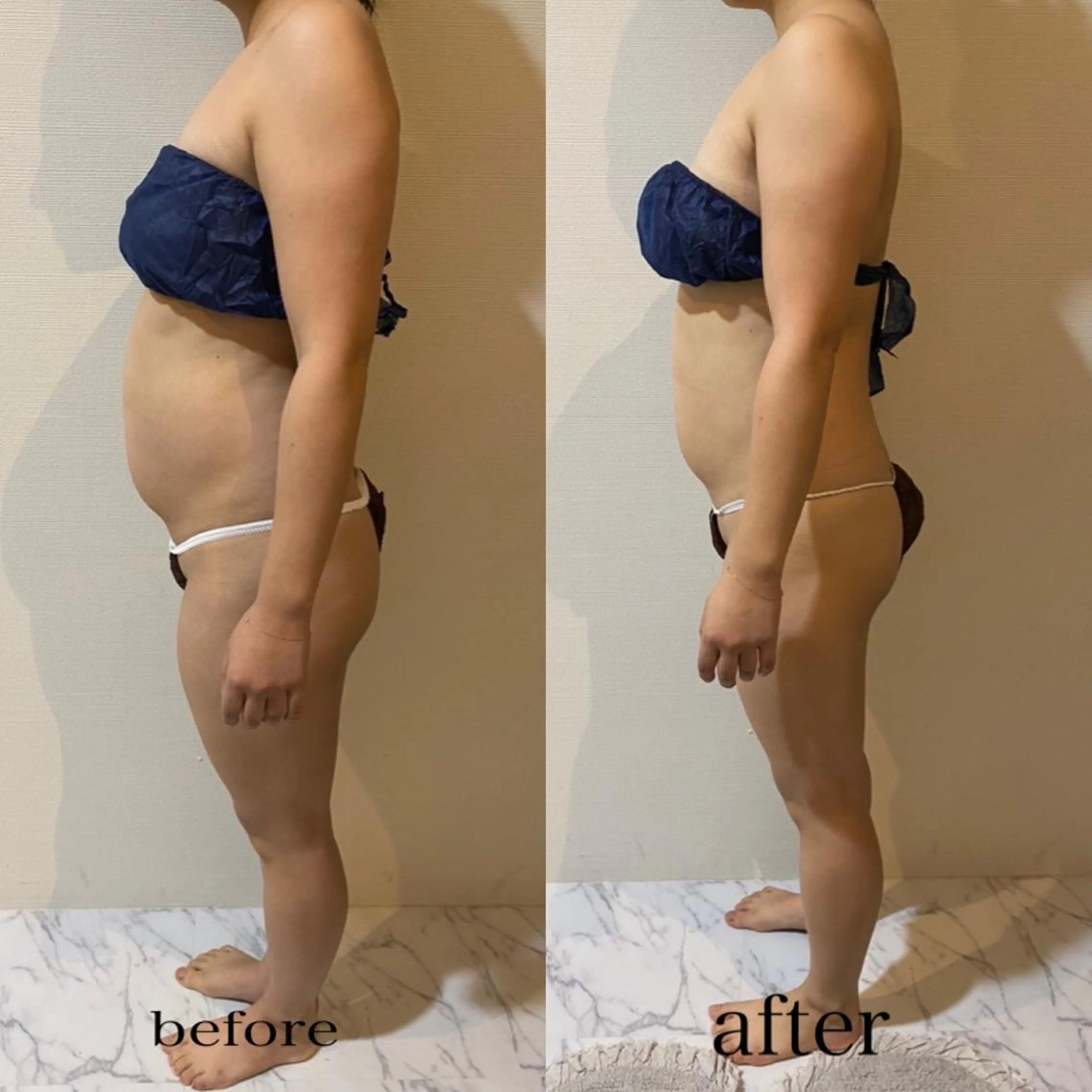 県内初導入✨効果すごい!キャビテーション痩せたい方必見の写真