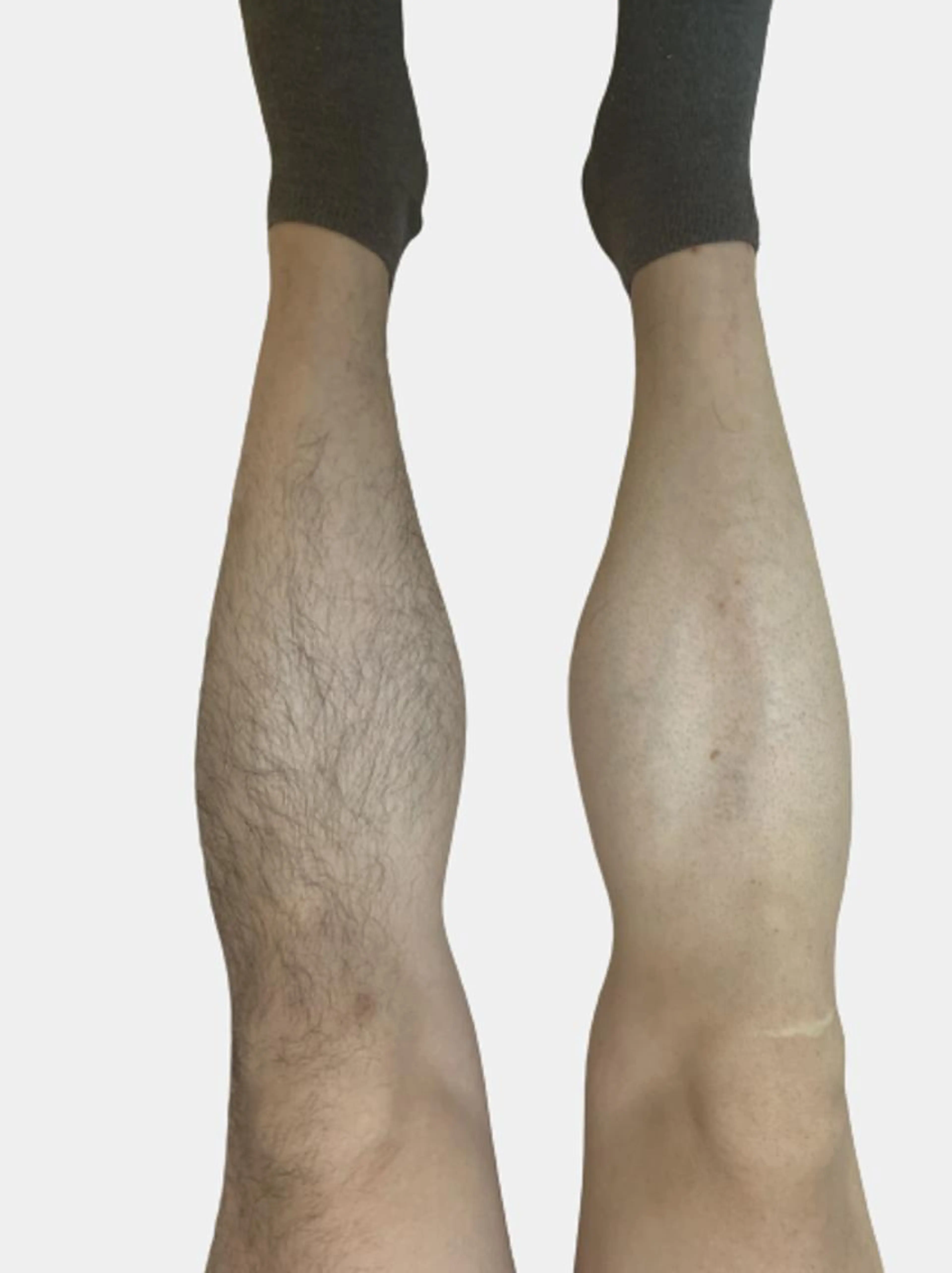 【安く脱毛したい方必見!】ボディ脱毛回数:1回の写真