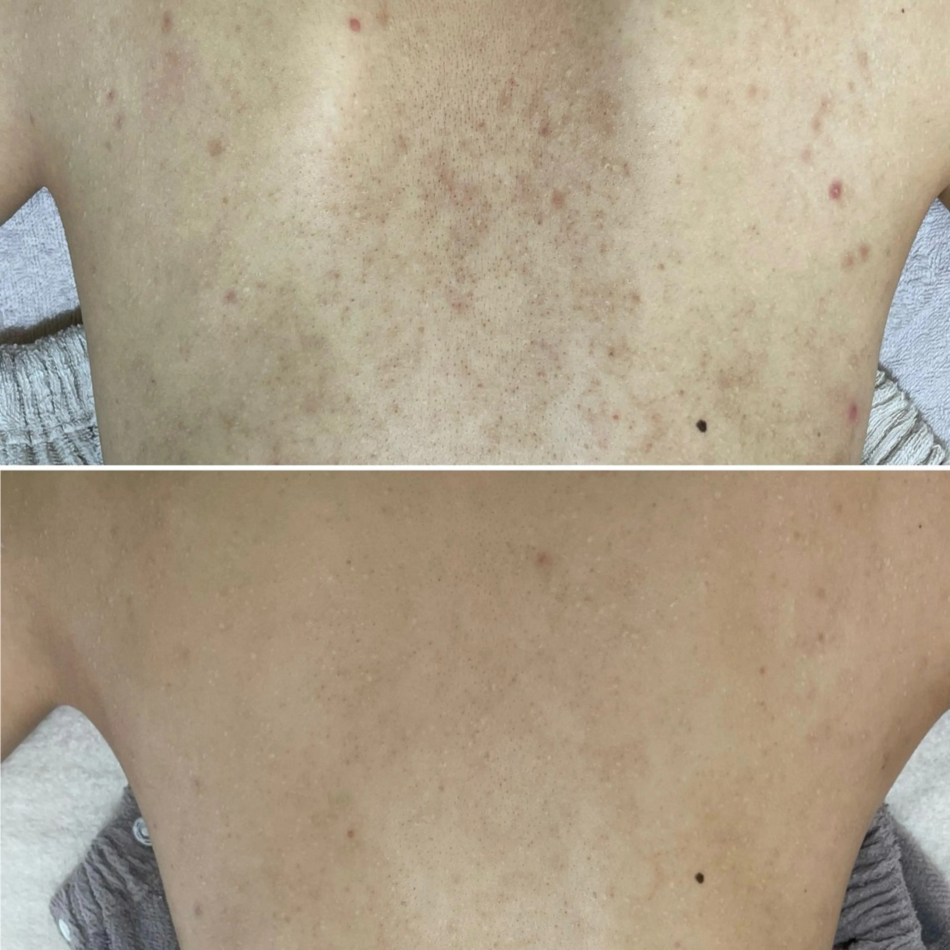 背中ニキビケアコース¥12,000の写真