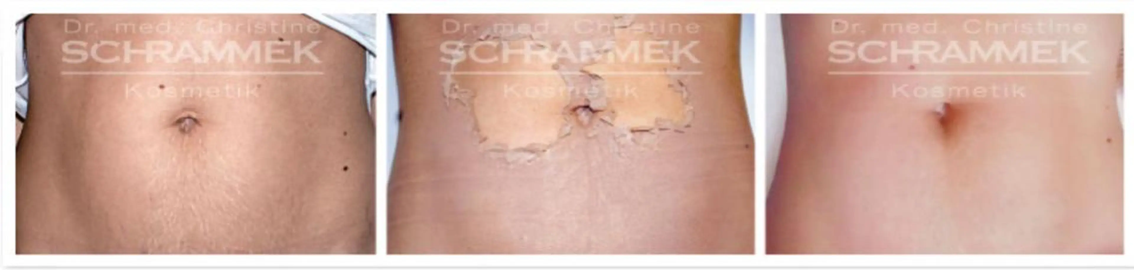 モニター価格！！グリーンピールボディー1Day90分コースの写真