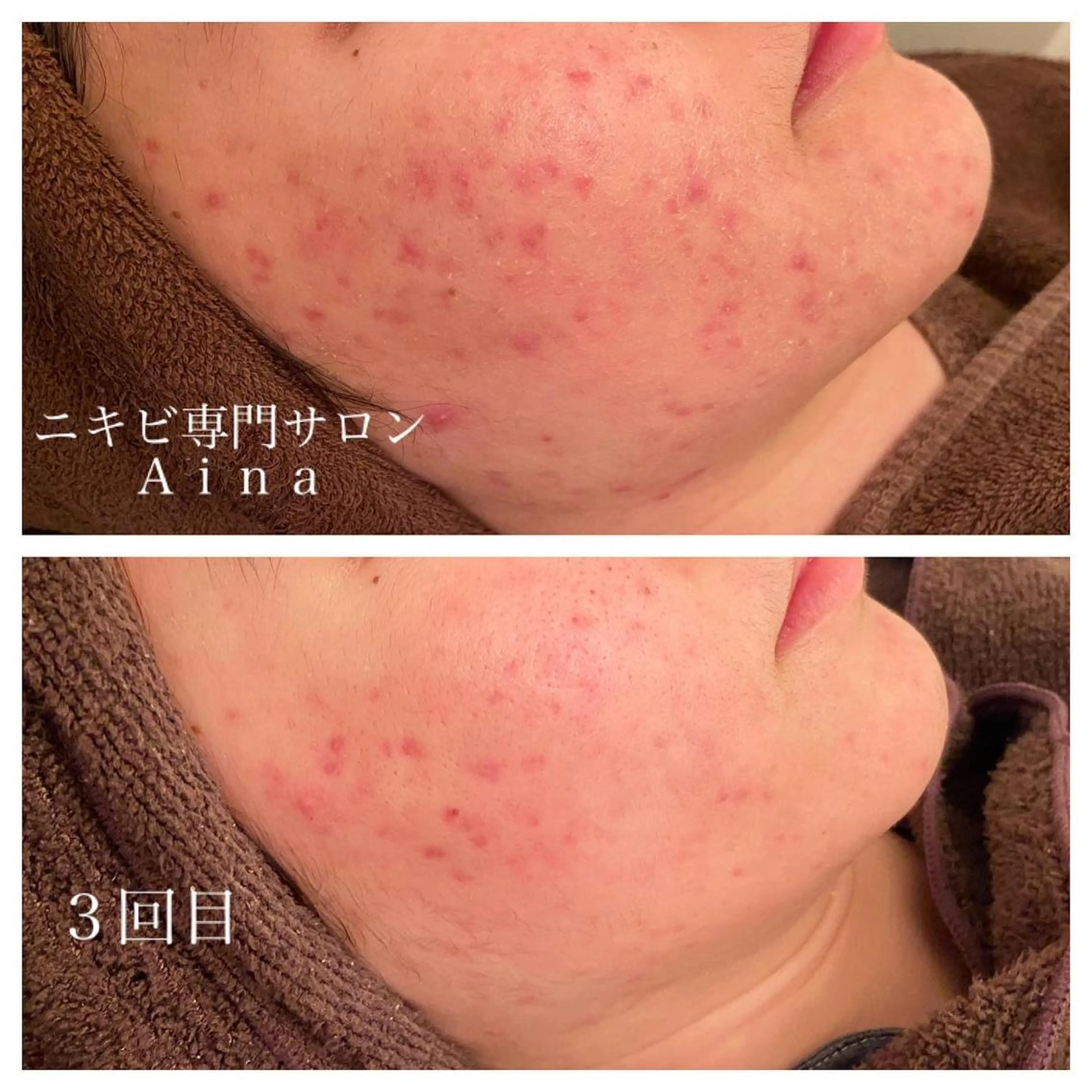 ロング カラー パーマ ヘアアレンジ メンズ キッズ ネイル マツエク・マツパ エステ リラク ニキビ跡専門サロン Ａｉｎａのエステ・リラクイメージ