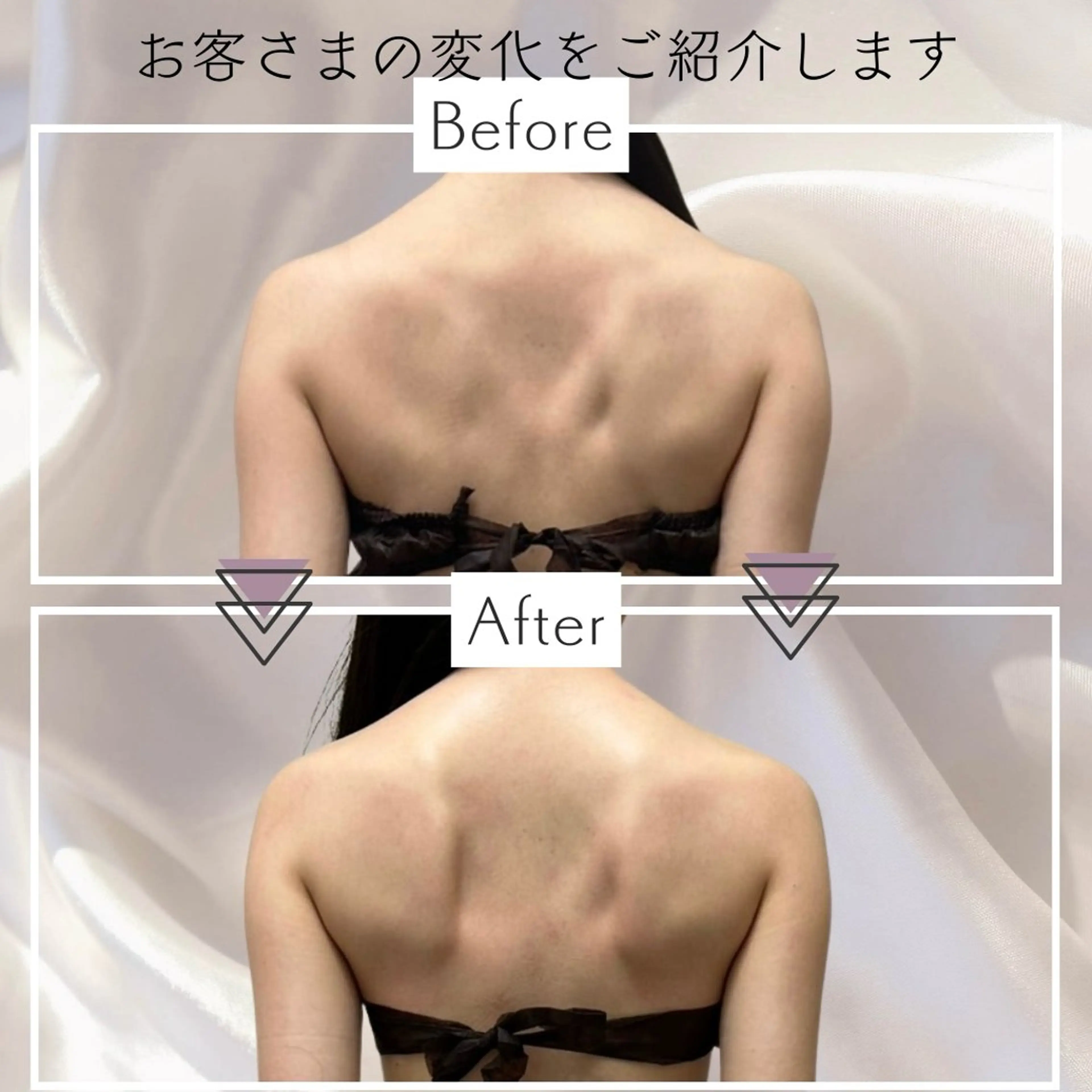 【駆け込みブライダル💍】ボディハイパーナイフ+ボディコルギ+フェイシャルハイパーナイフ+EMSの写真