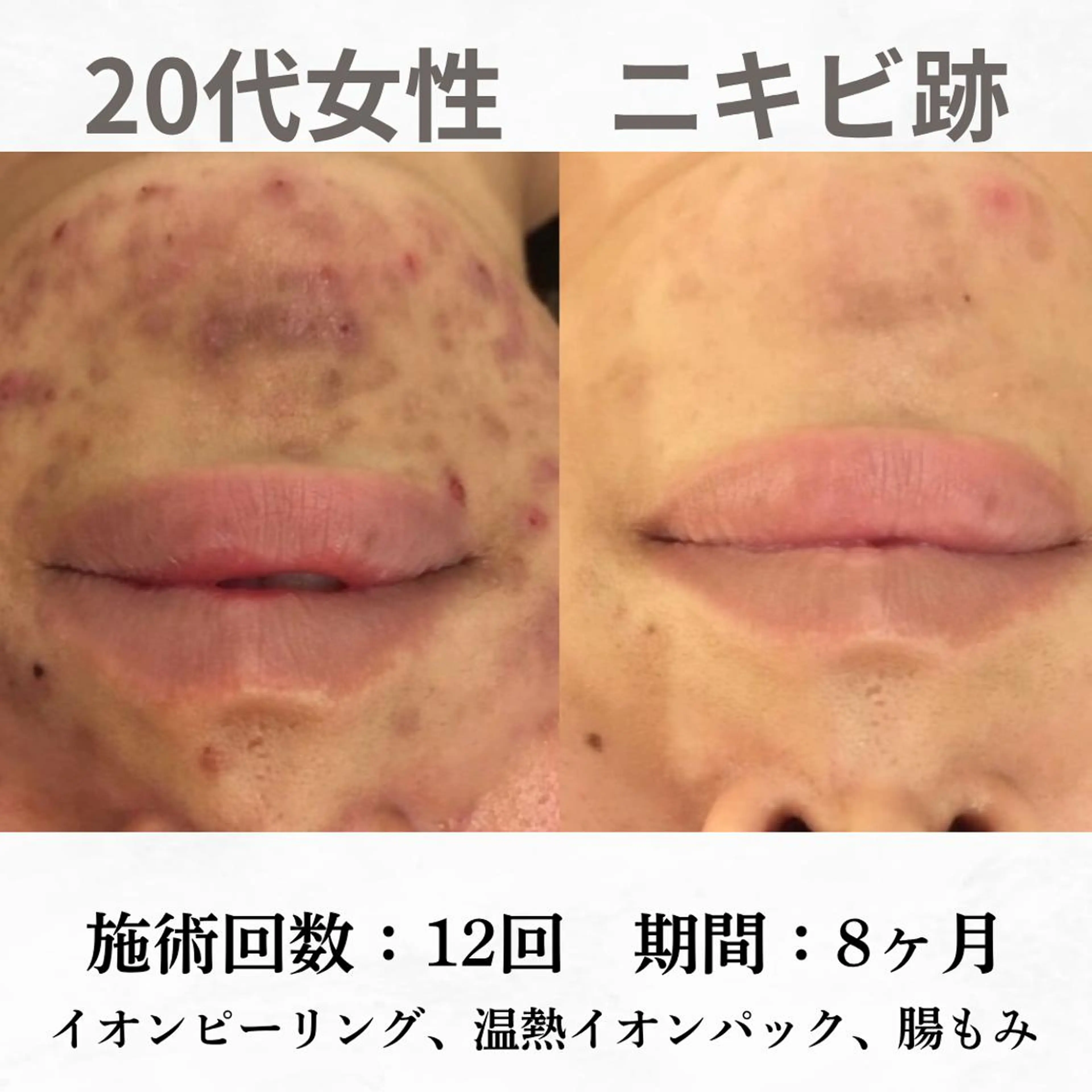 重度ニキビ専門🌷 ダウンタイムなしのエステ・リラクイメージ