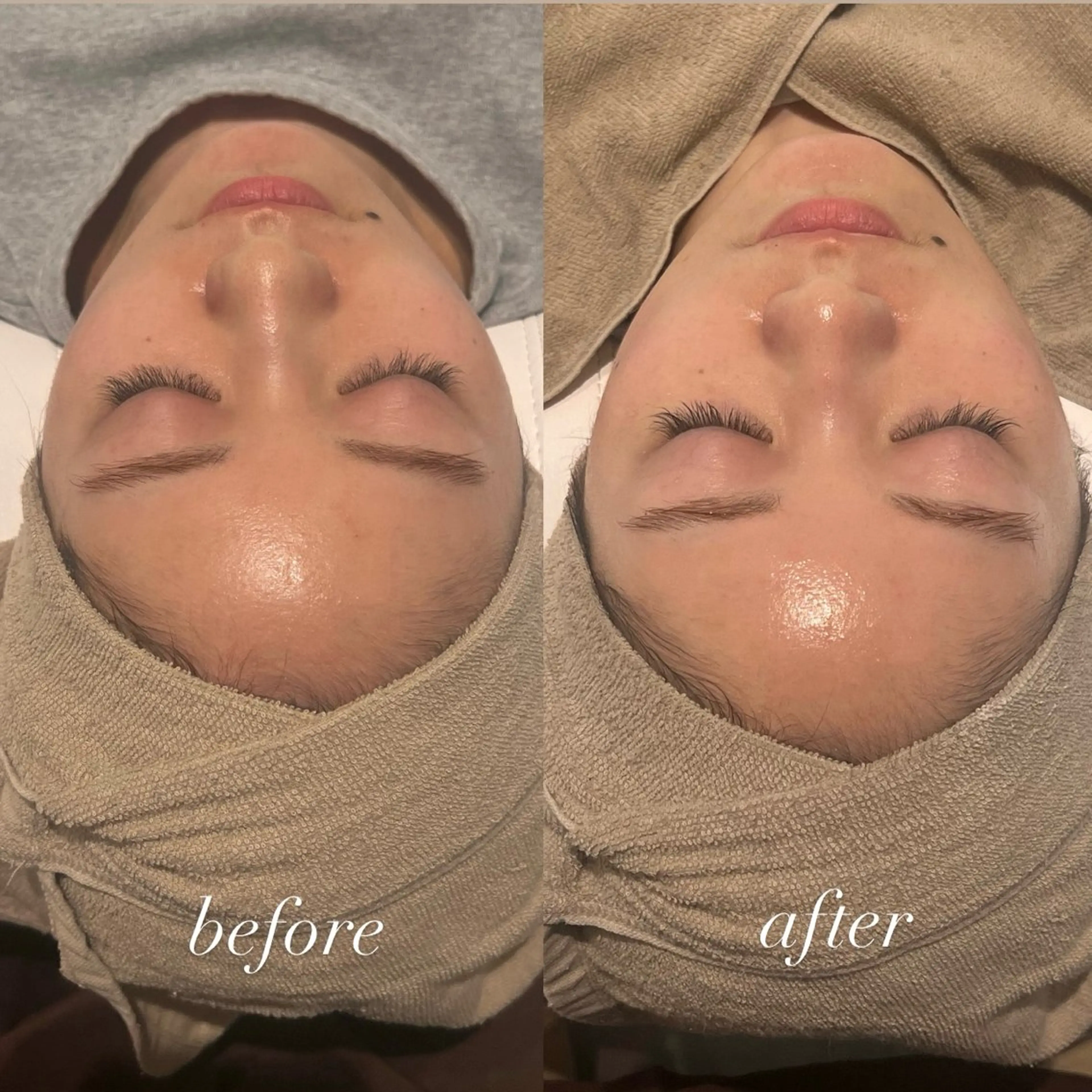 【肌質改善】クリスティーナ ビオフィートシリーズ ハーブピーリング🌿の写真