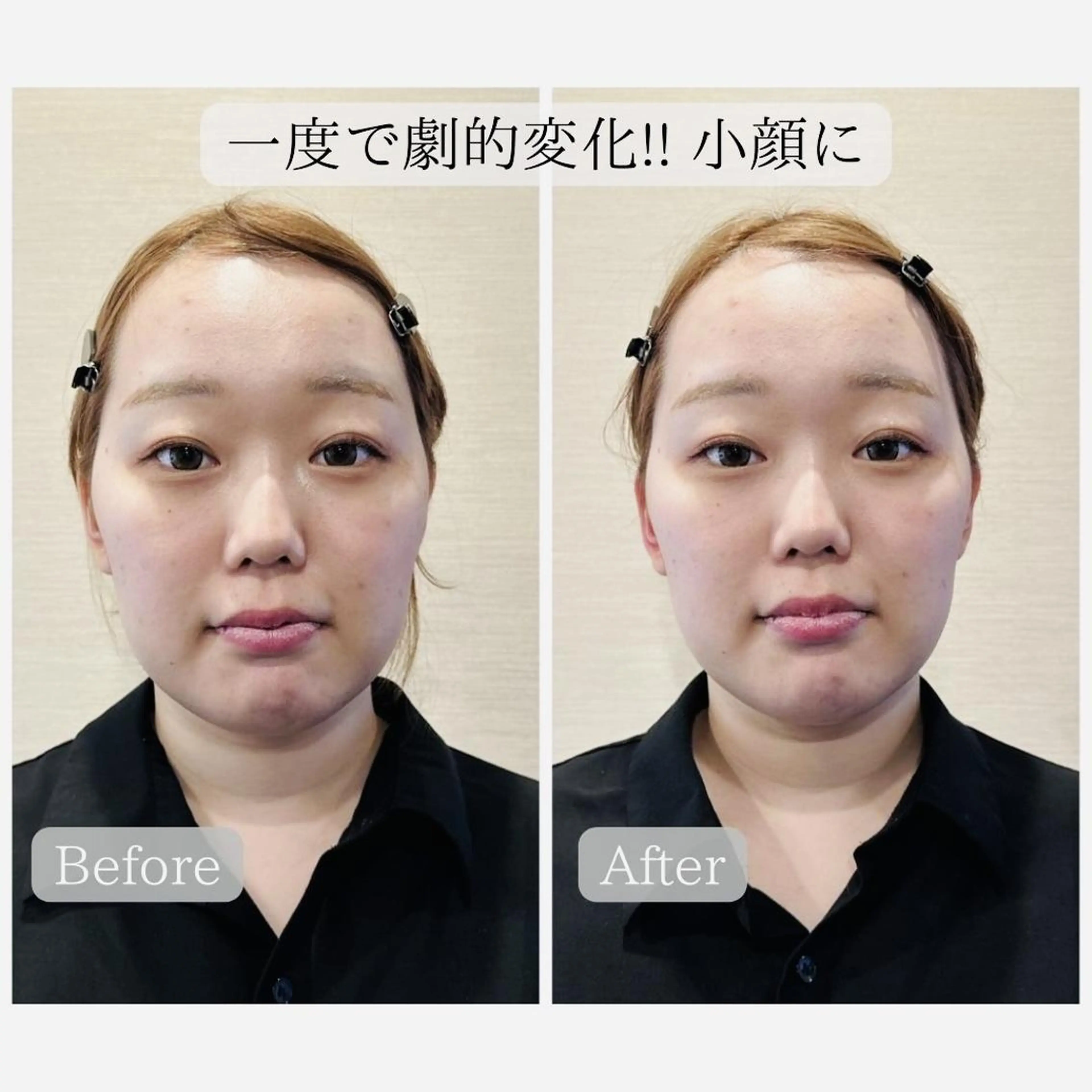 🌟人気NO.1🌟【骨格から美眉毛に💎🫧】小顔矯正＆美眉WAXスタイリング＆バブル保湿パック 仙台/あおば通駅の写真